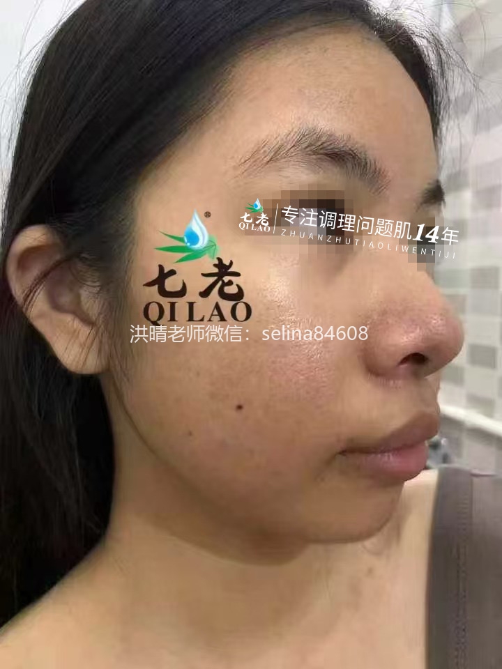 七老激素脸激素痘痘玫瑰皮修护案例