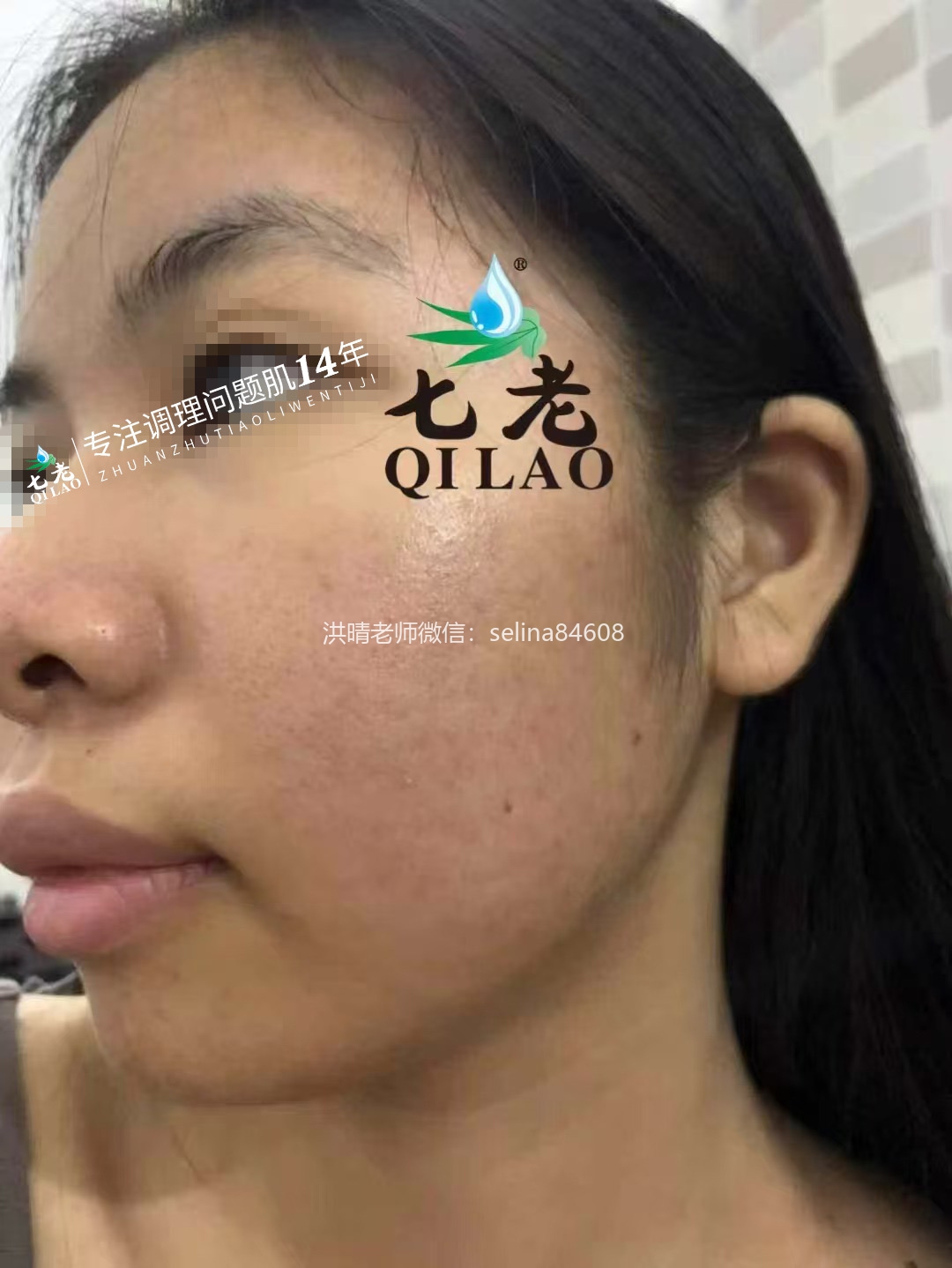 七老激素脸激素痘痘玫瑰皮修护案例