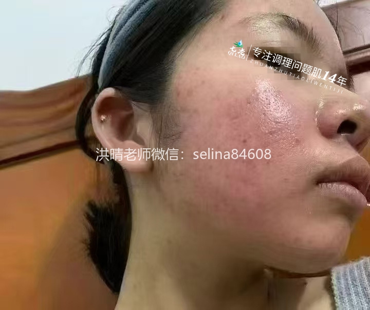 七老激素脸激素痘痘玫瑰皮修护案例