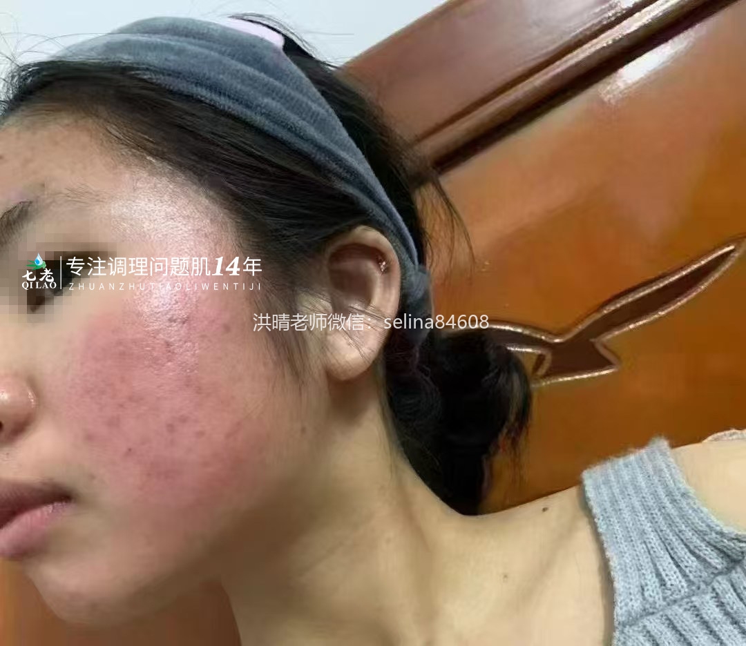 七老激素脸激素痘痘玫瑰皮修护案例