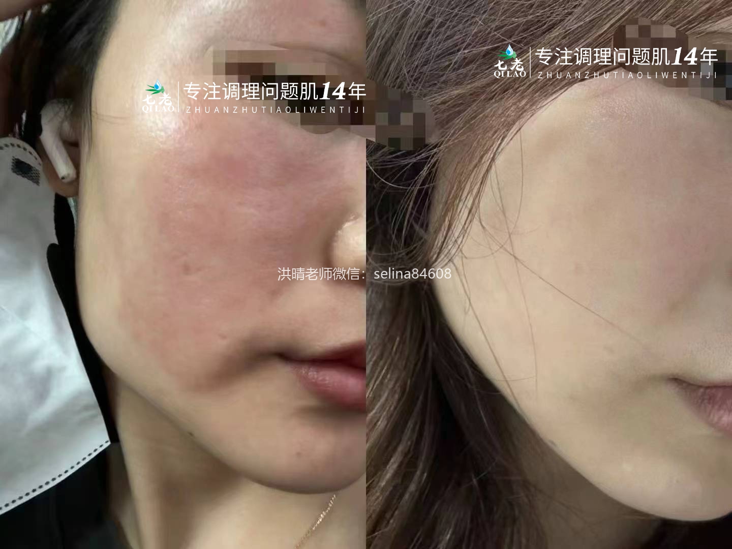 七老屏障受损红烫大红脸修护对比