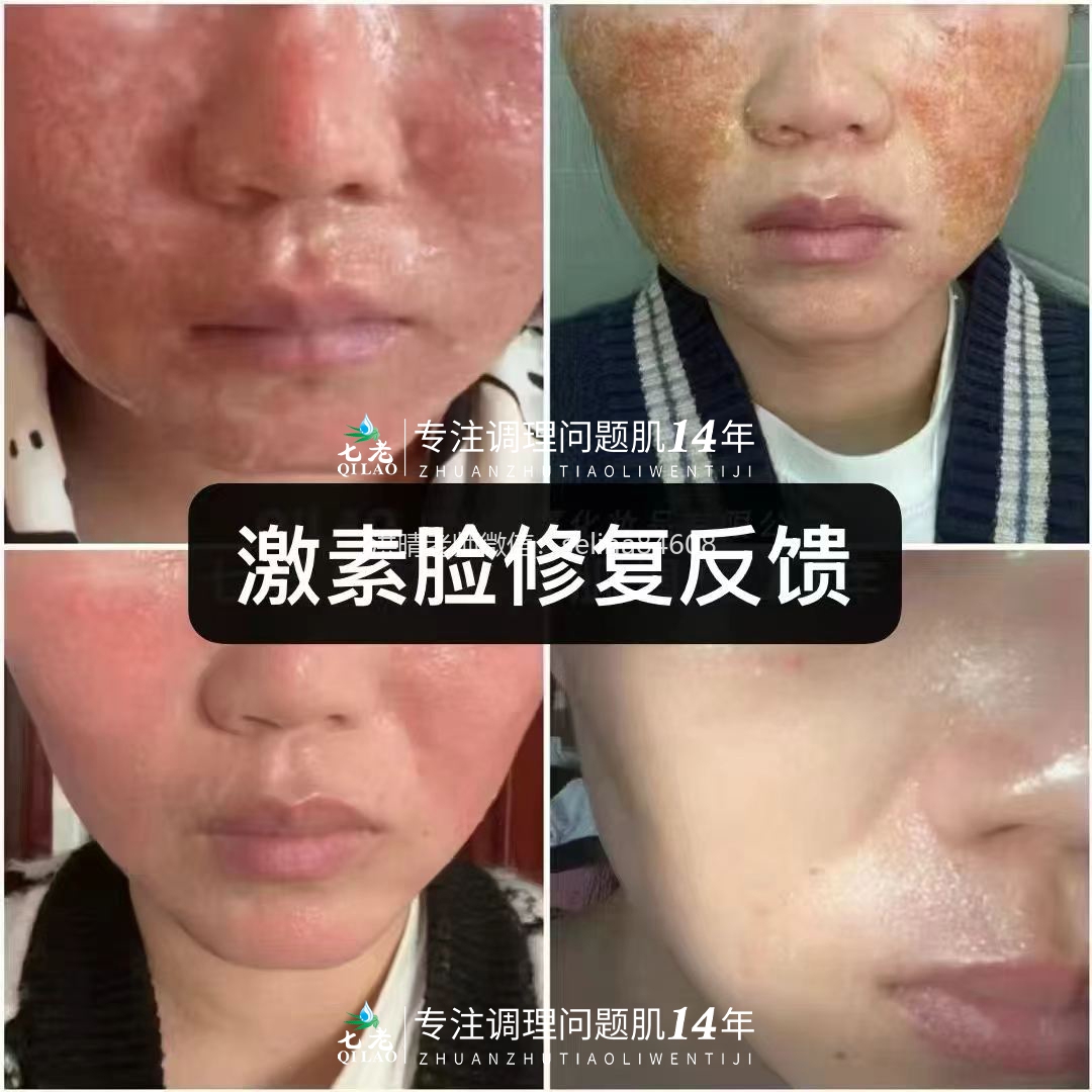 七老激素脸烂脸修护案例
