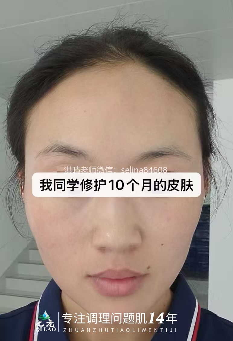 七老激素脸流黄水结痂修护案例