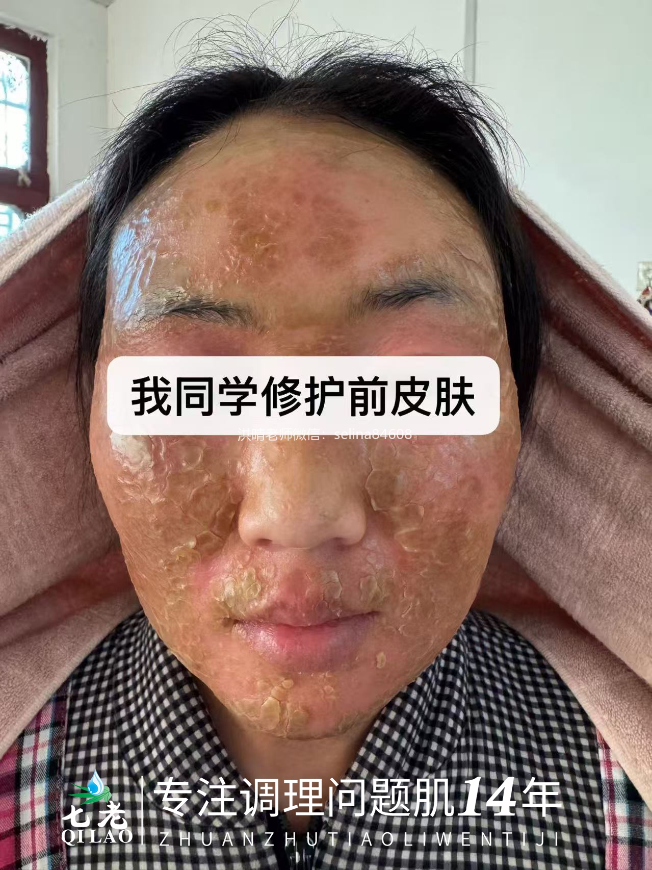 七老激素脸流黄水结痂修护案例