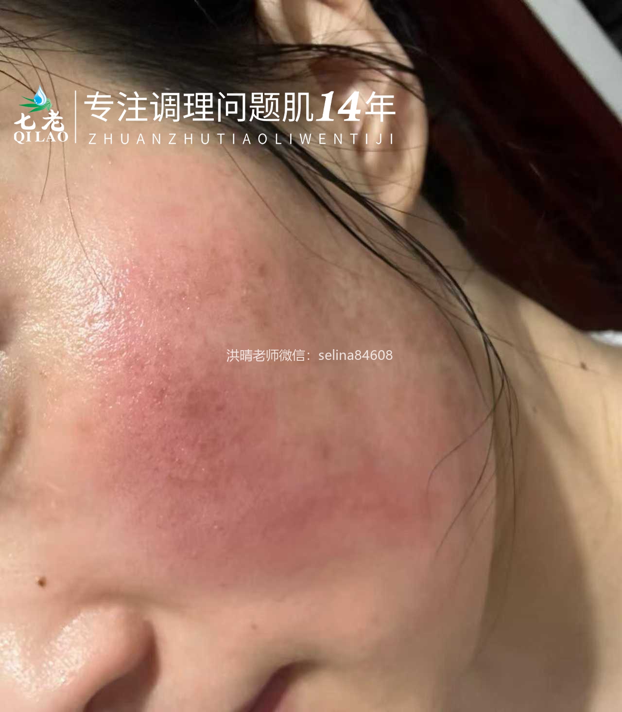七老激素脸玫瑰神经性红烫大红脸修护案例