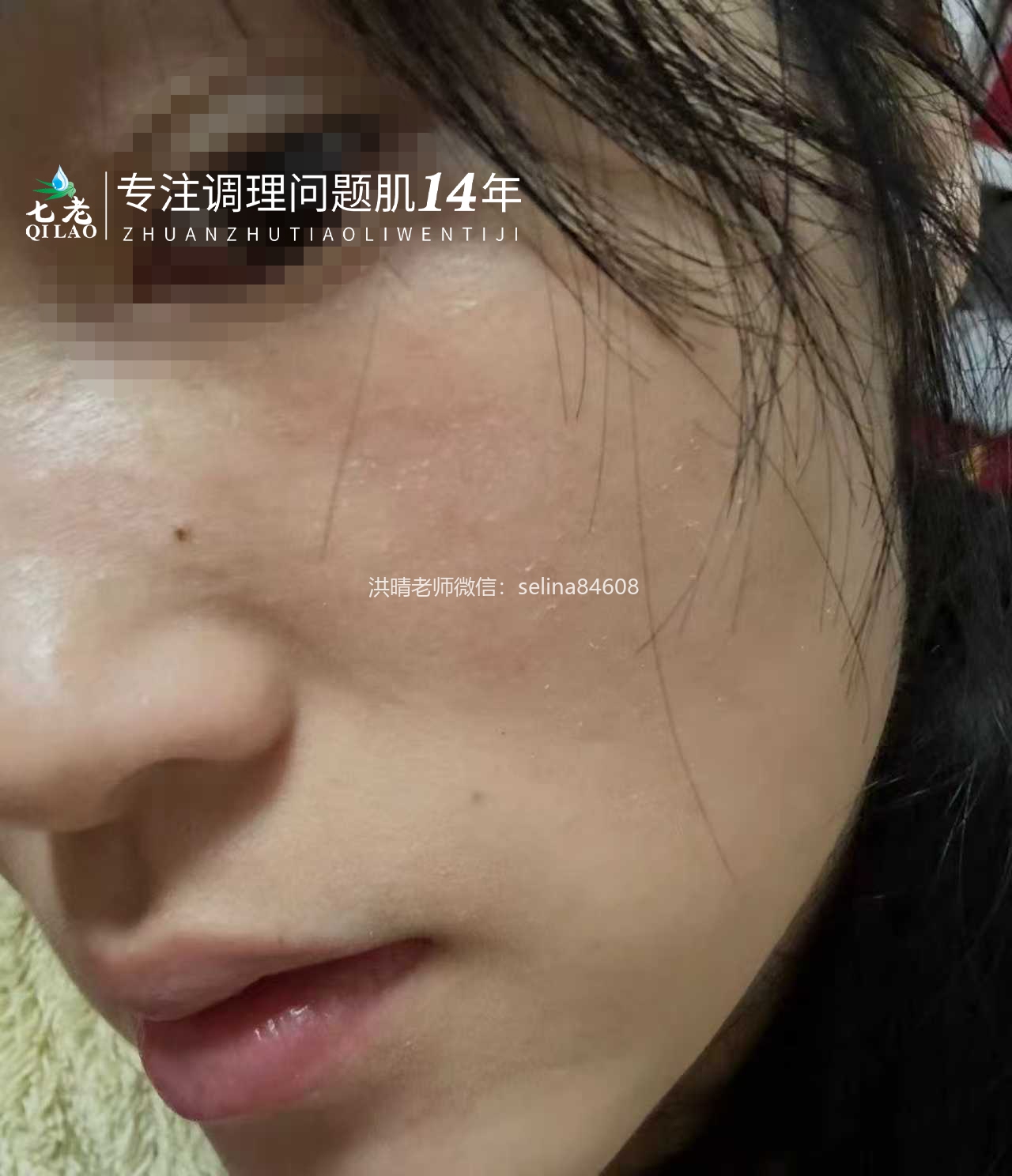 七老激素脸玫瑰神经性红烫大红脸修护案例
