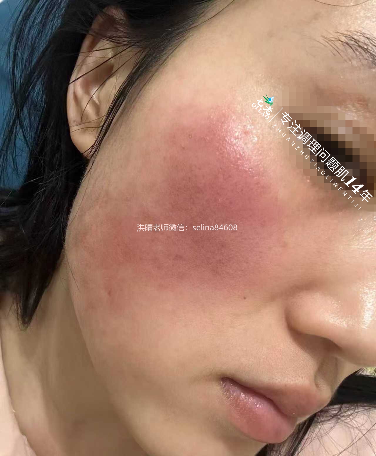 七老激素脸玫瑰神经性红烫大红脸修护案例
