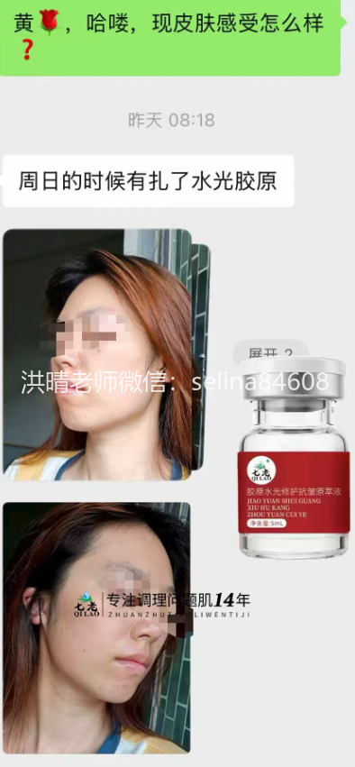 七老敏感肌泛红刺痛用胶原水光三个月对比