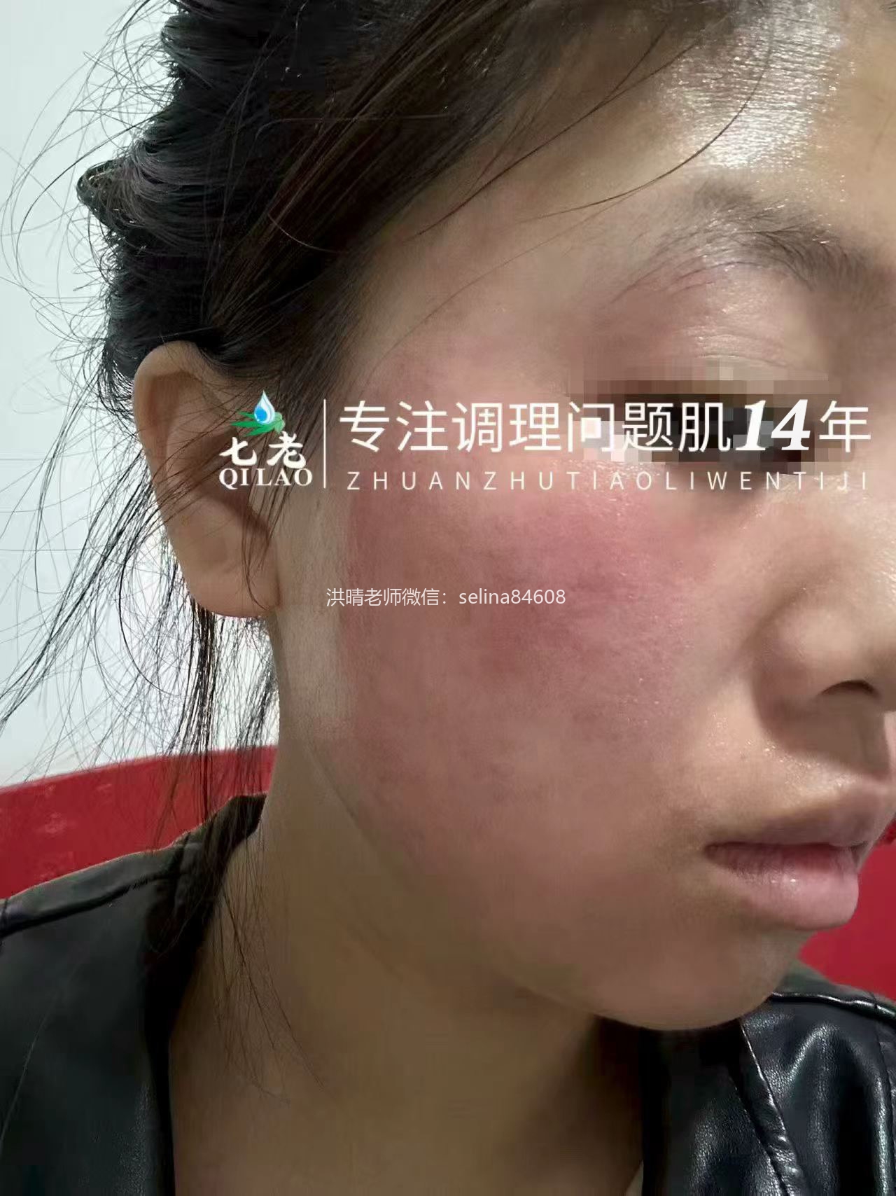 七老激素脸红肿痒疹子疙瘩修护案例
