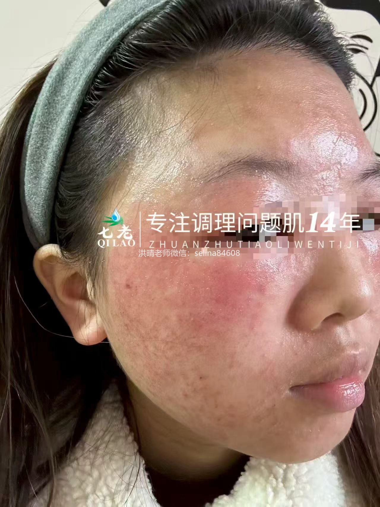 七老激素脸红肿痒疹子疙瘩修护案例