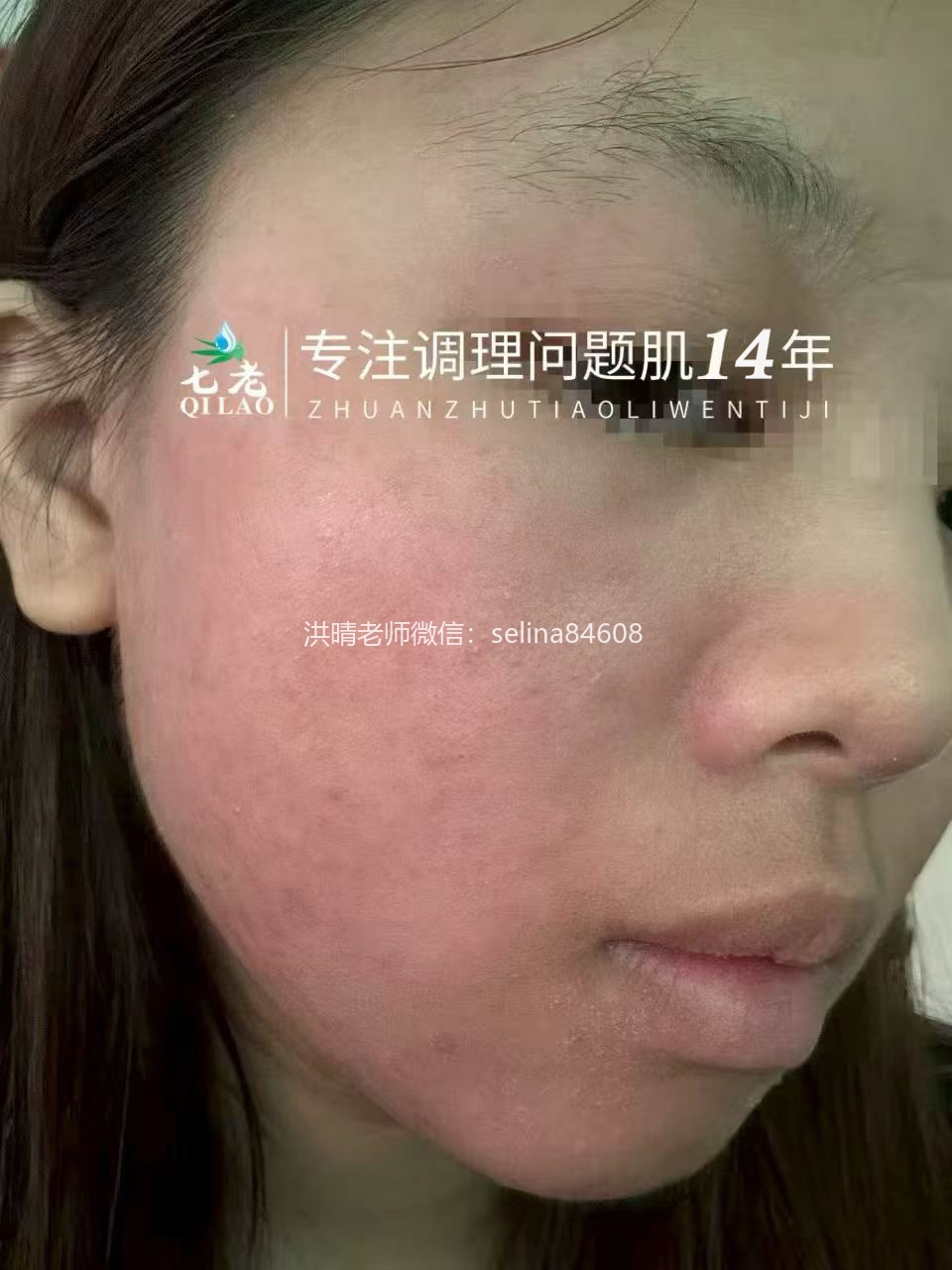 七老激素脸红肿痒疹子疙瘩修护案例