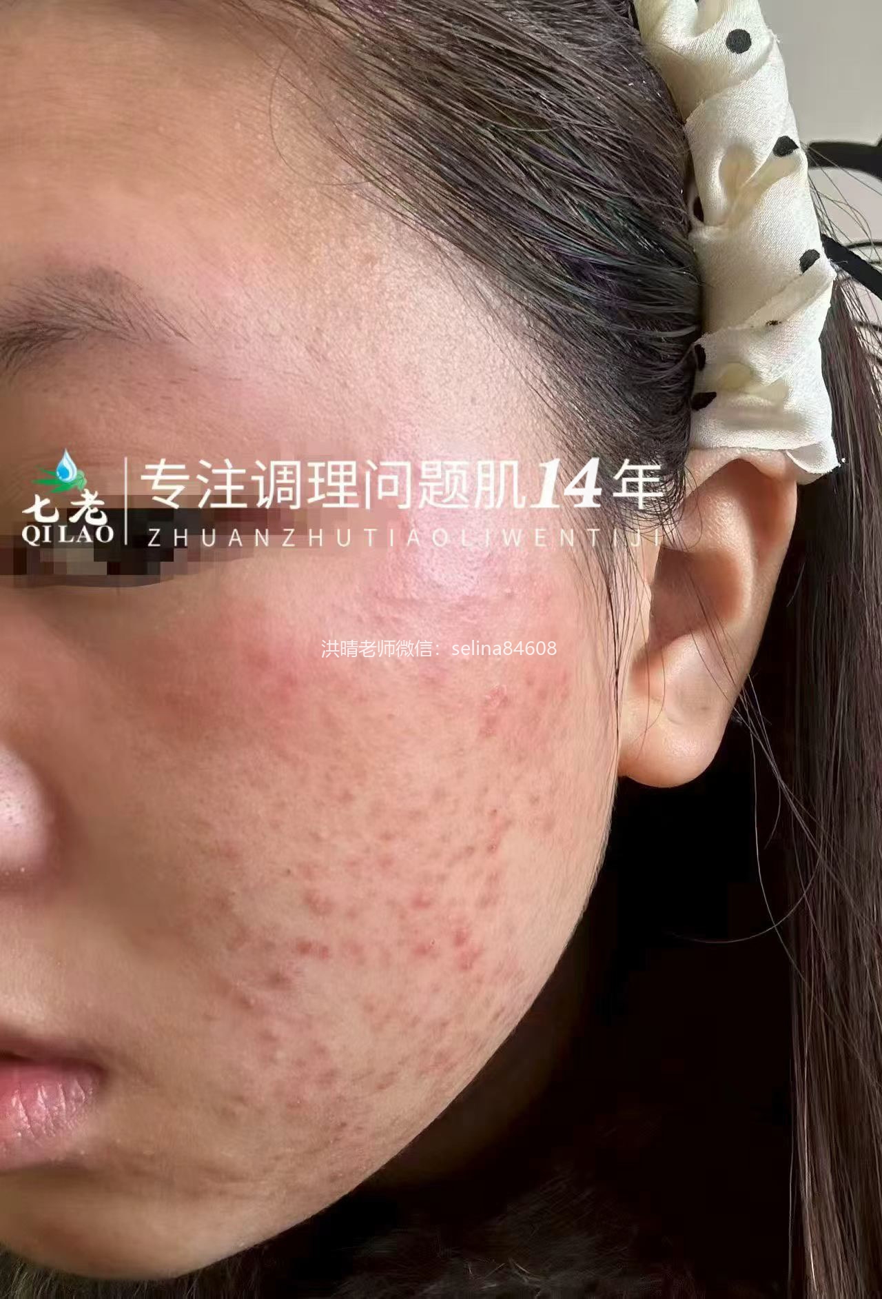 七老激素脸红肿痒疹子疙瘩修护案例
