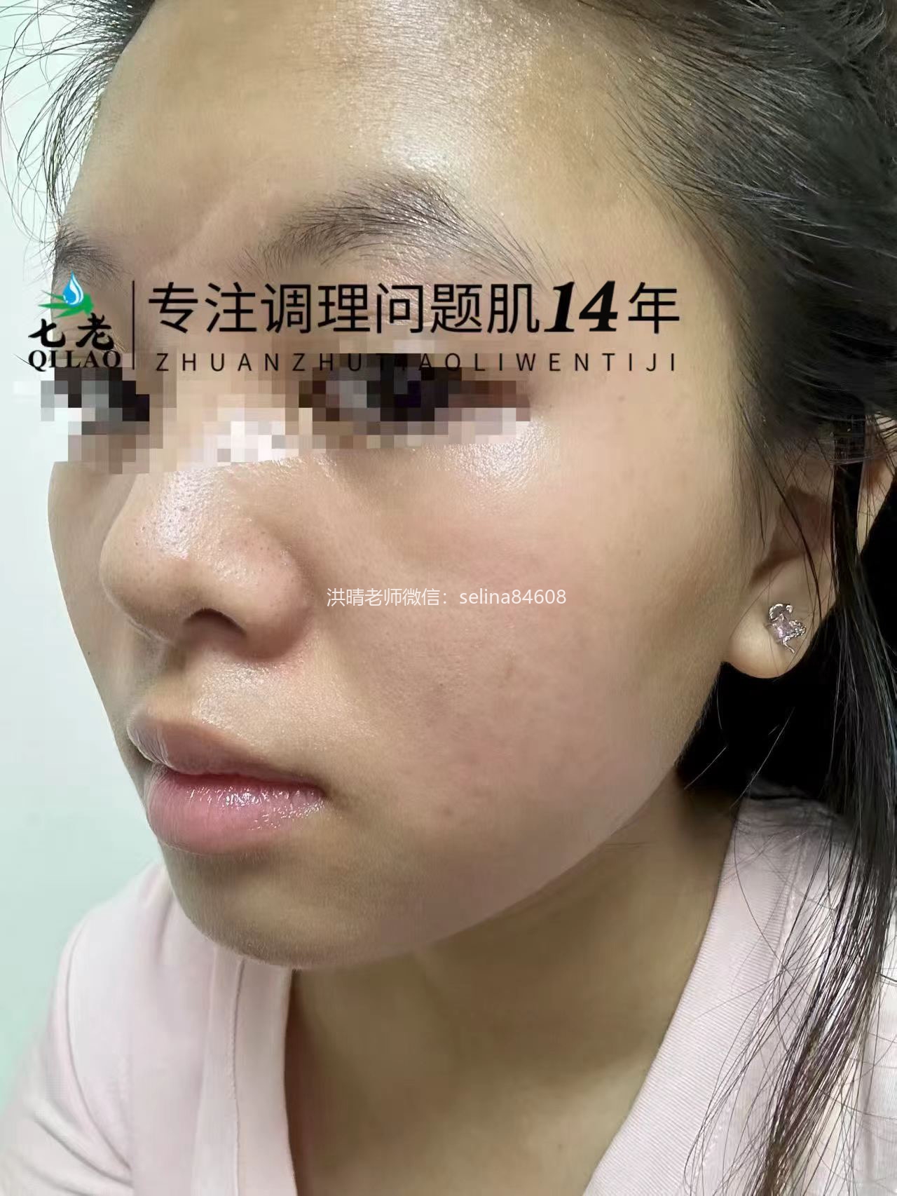 七老激素脸红肿痒疹子疙瘩修护案例
