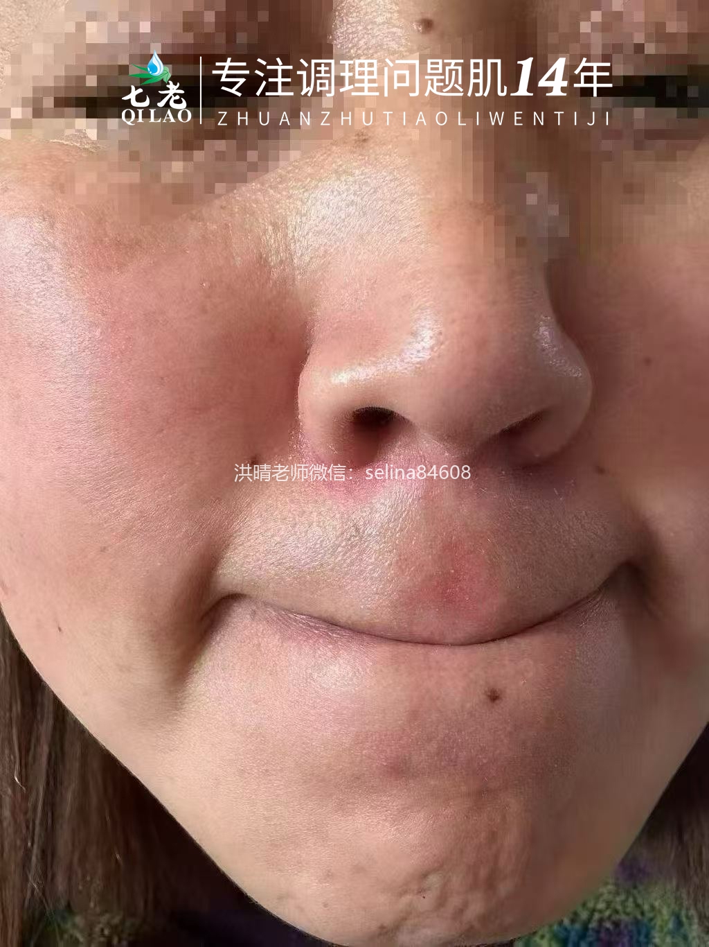 七老脂溢性皮炎泛红疹子干痒脱皮修护案例