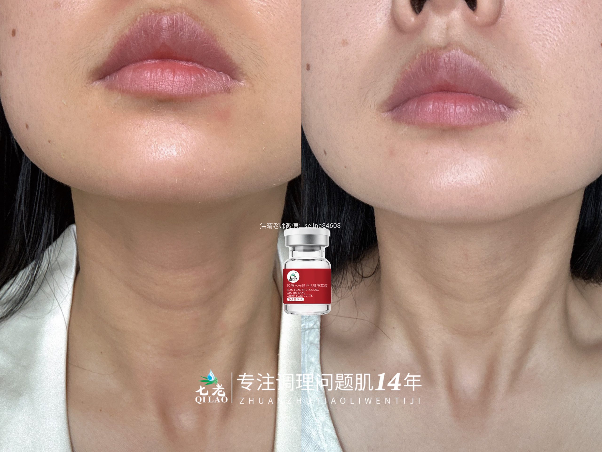 七老胶原水光6次的效果对比，对颈纹也很绝绝子