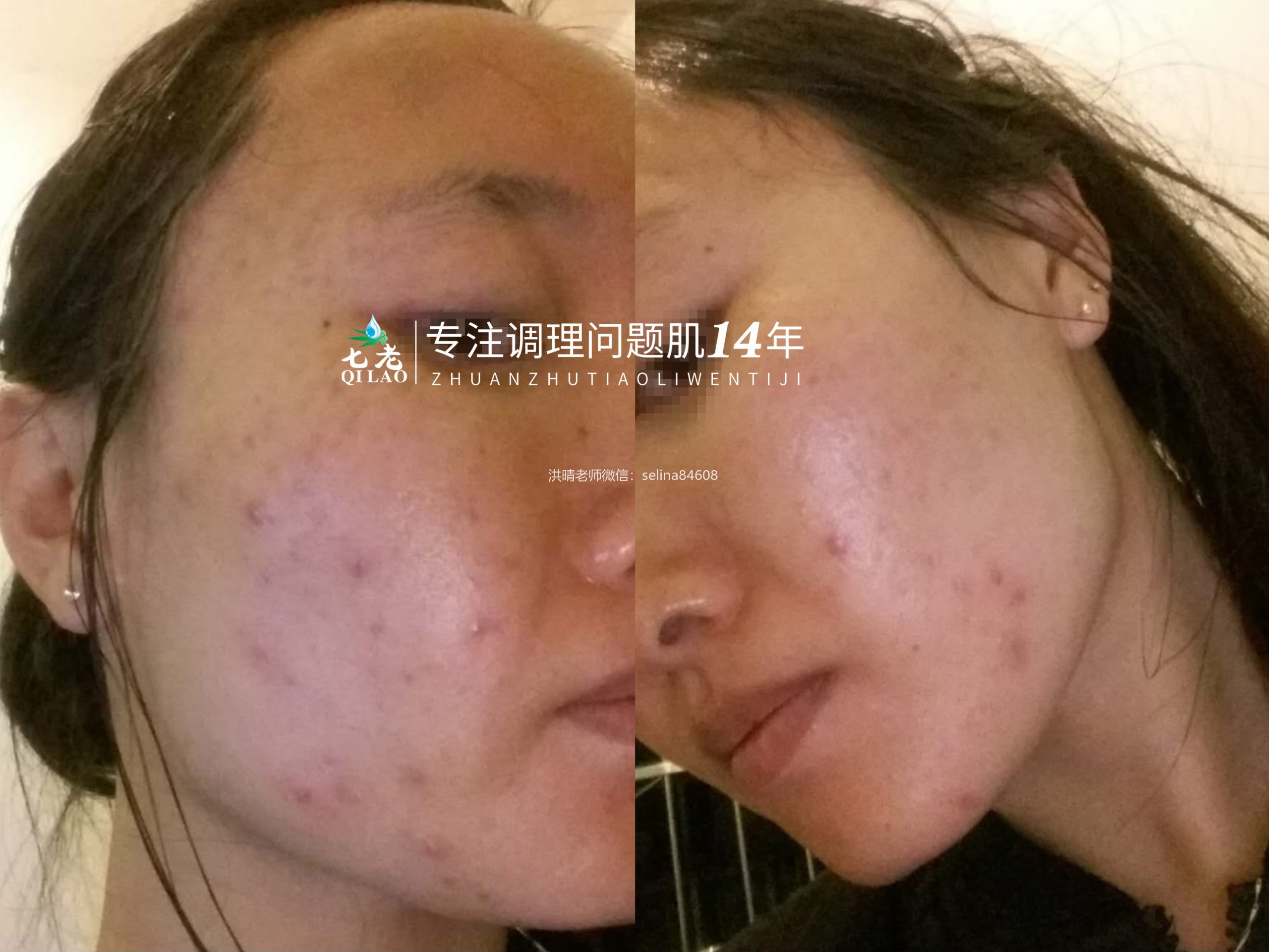 七老皮肤长痘痘痘修护案例