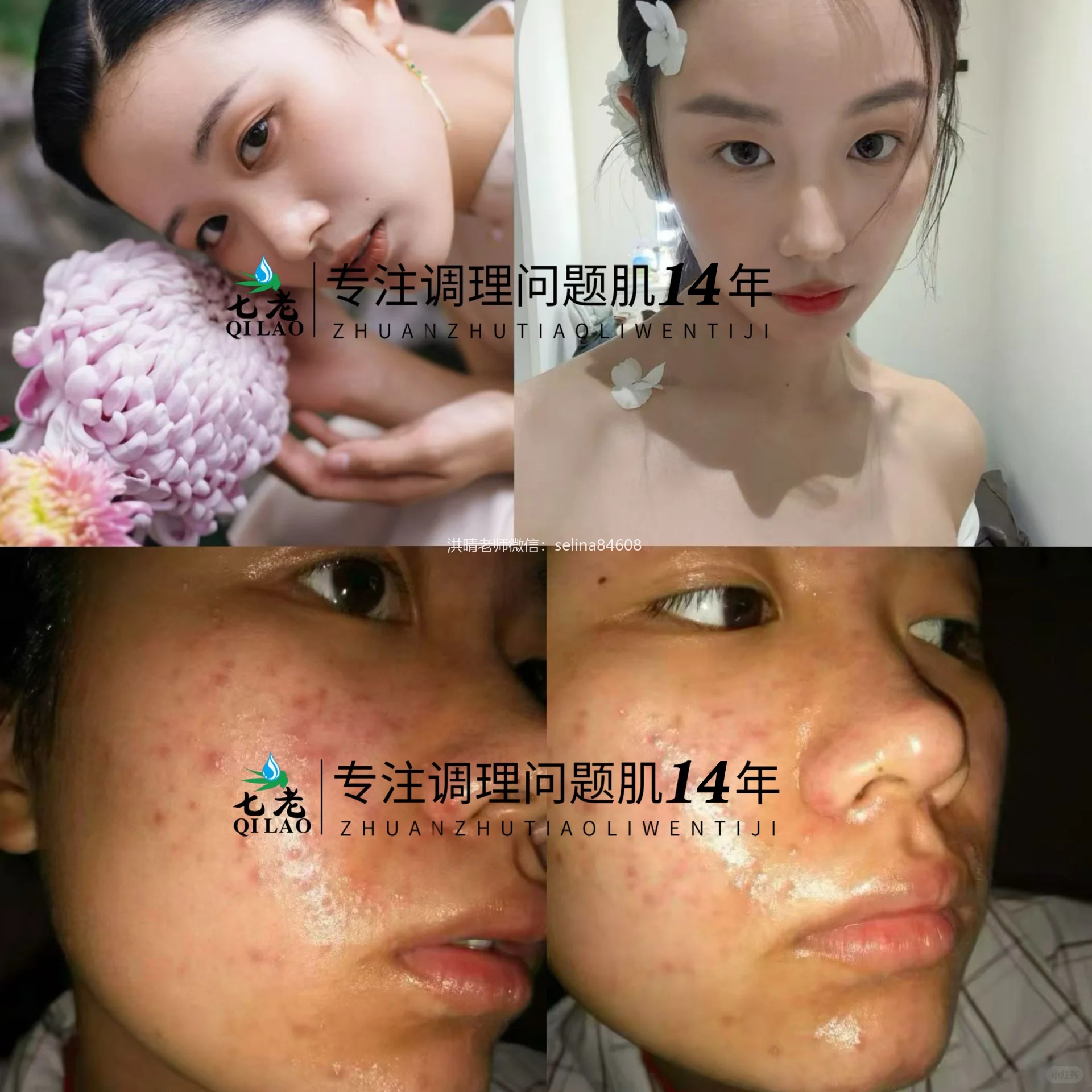 七老亲润安肤精华→油敏肌玫瑰皮，脂皮必备