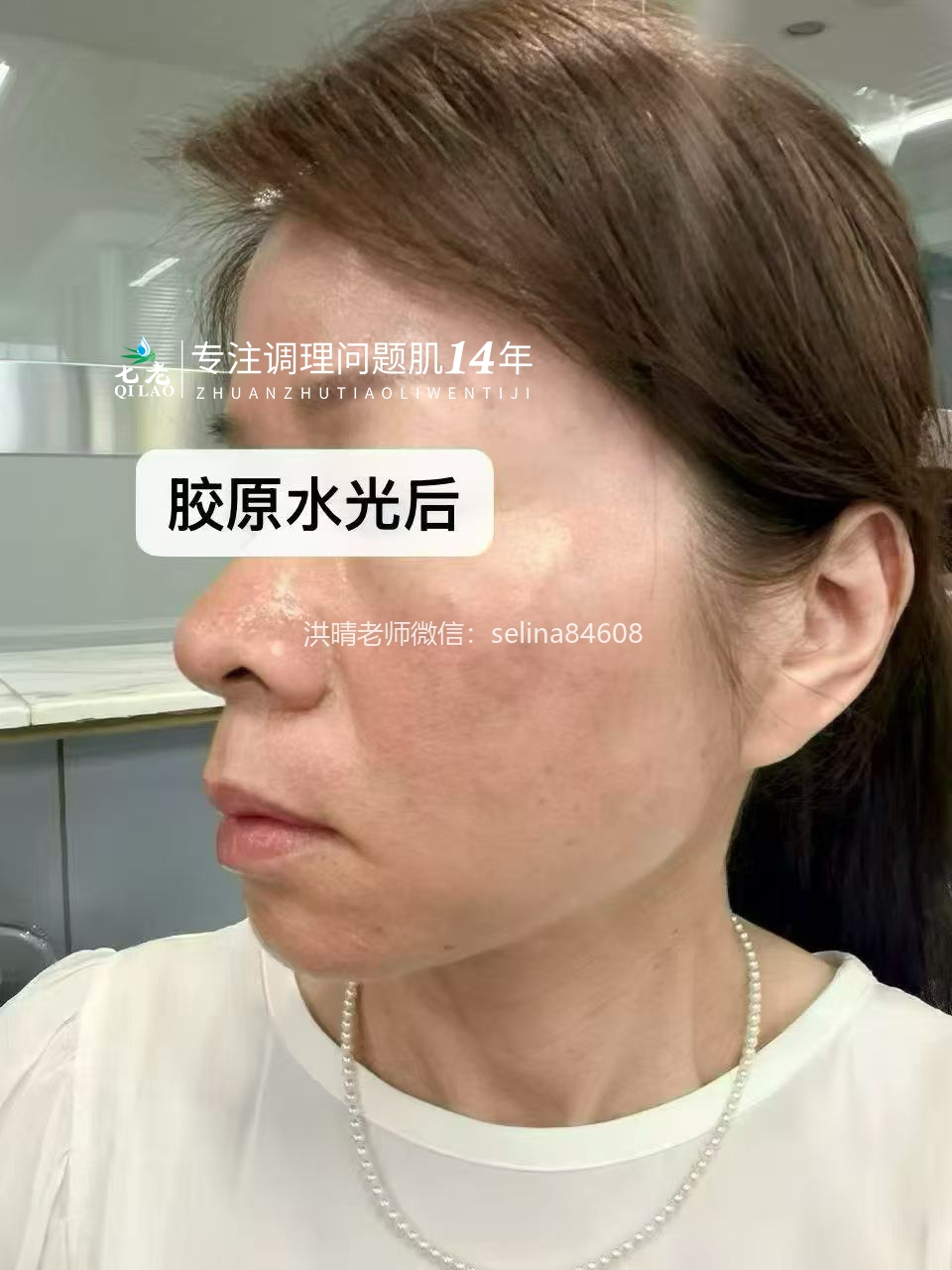 七老激素脸➕玫瑰痤疮➕脂皮修护案例