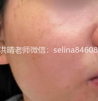 七老胶原水光➕传明酸→红就不退，黑红脸最佳搭配