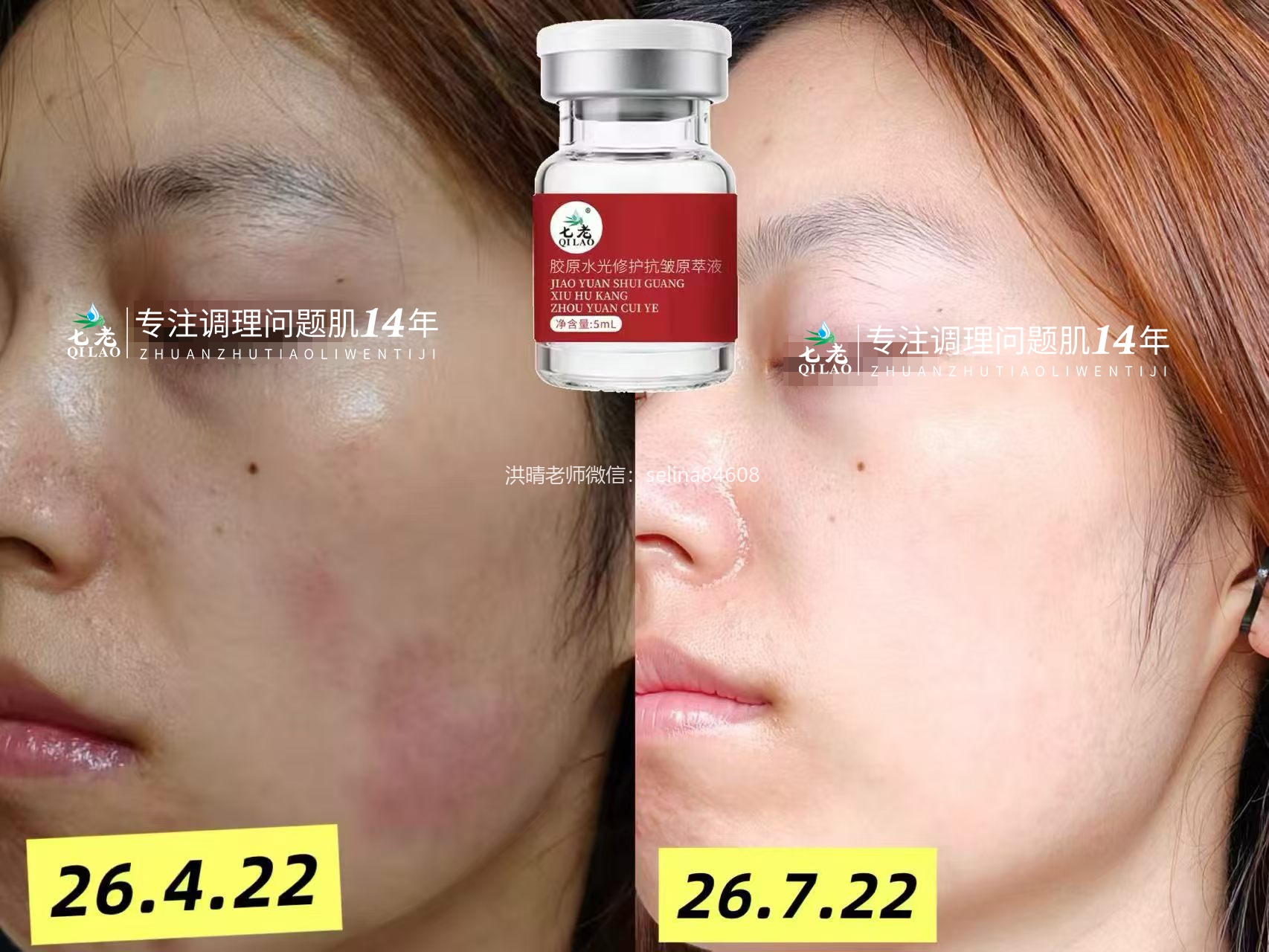 七老敏感肌泛红刺痛用胶原水光三个月对比