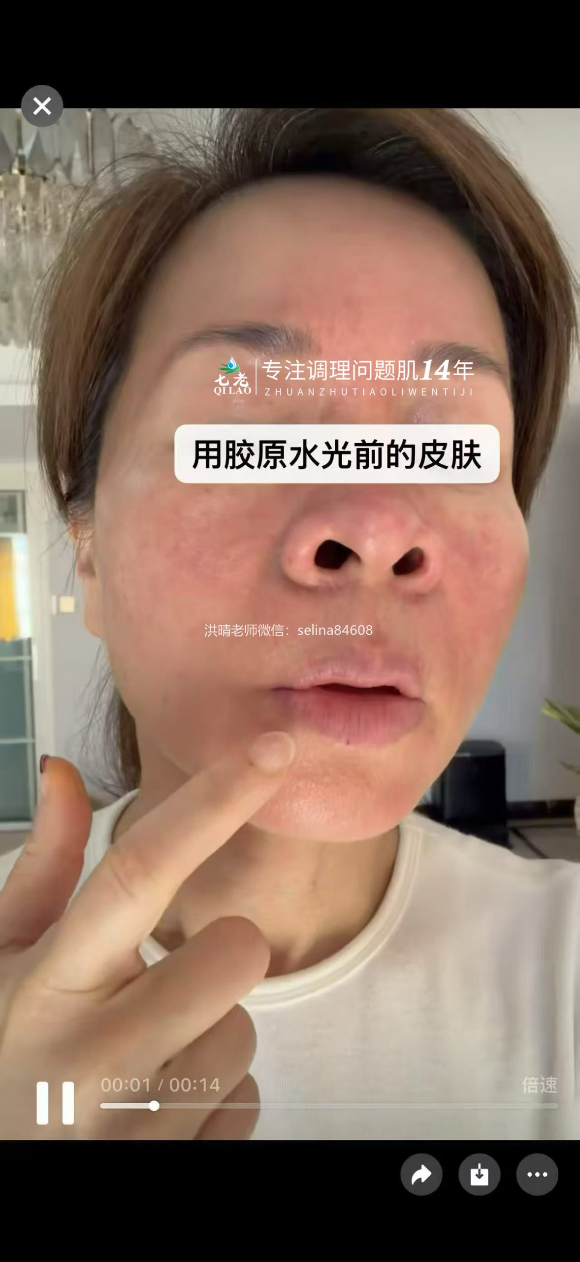 七老激素脸➕玫瑰痤疮➕脂皮修护案例
