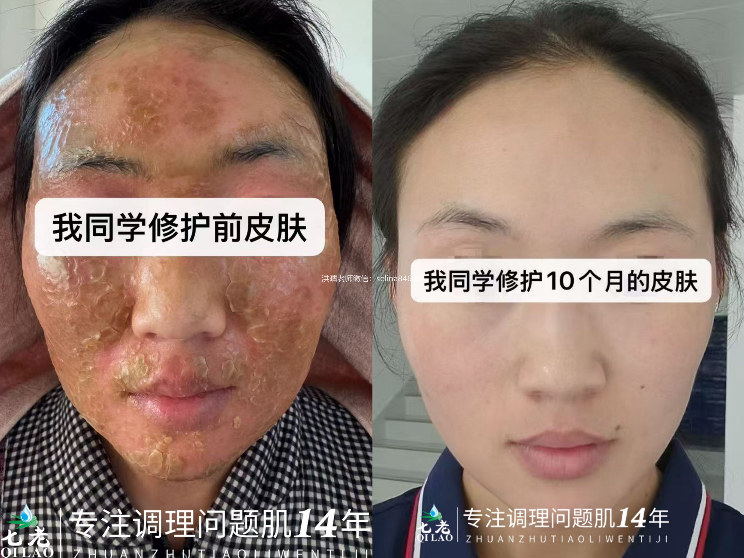 七老激素脸流黄水结痂修护案例