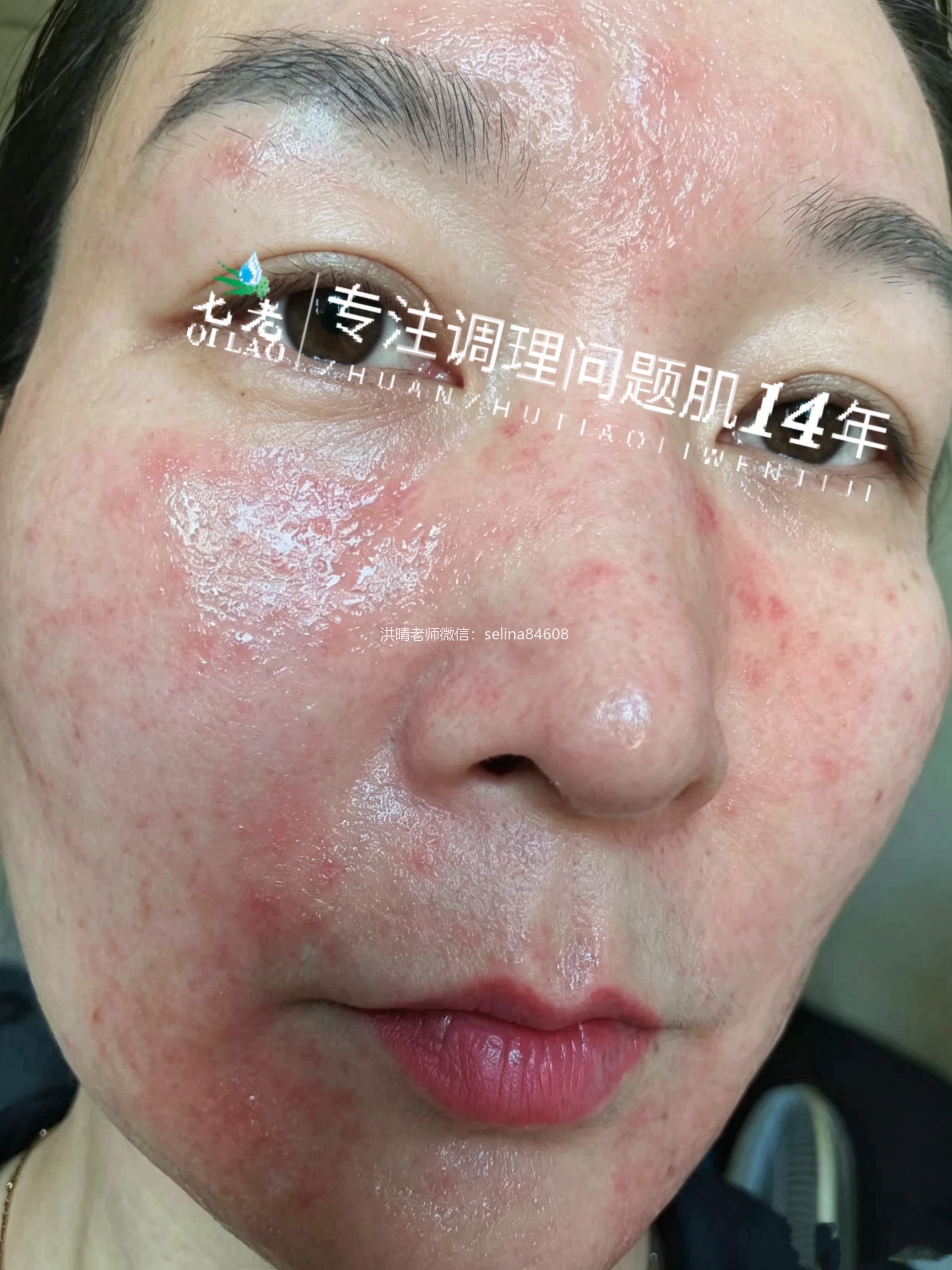 七老急性皮炎湿疹修护案例