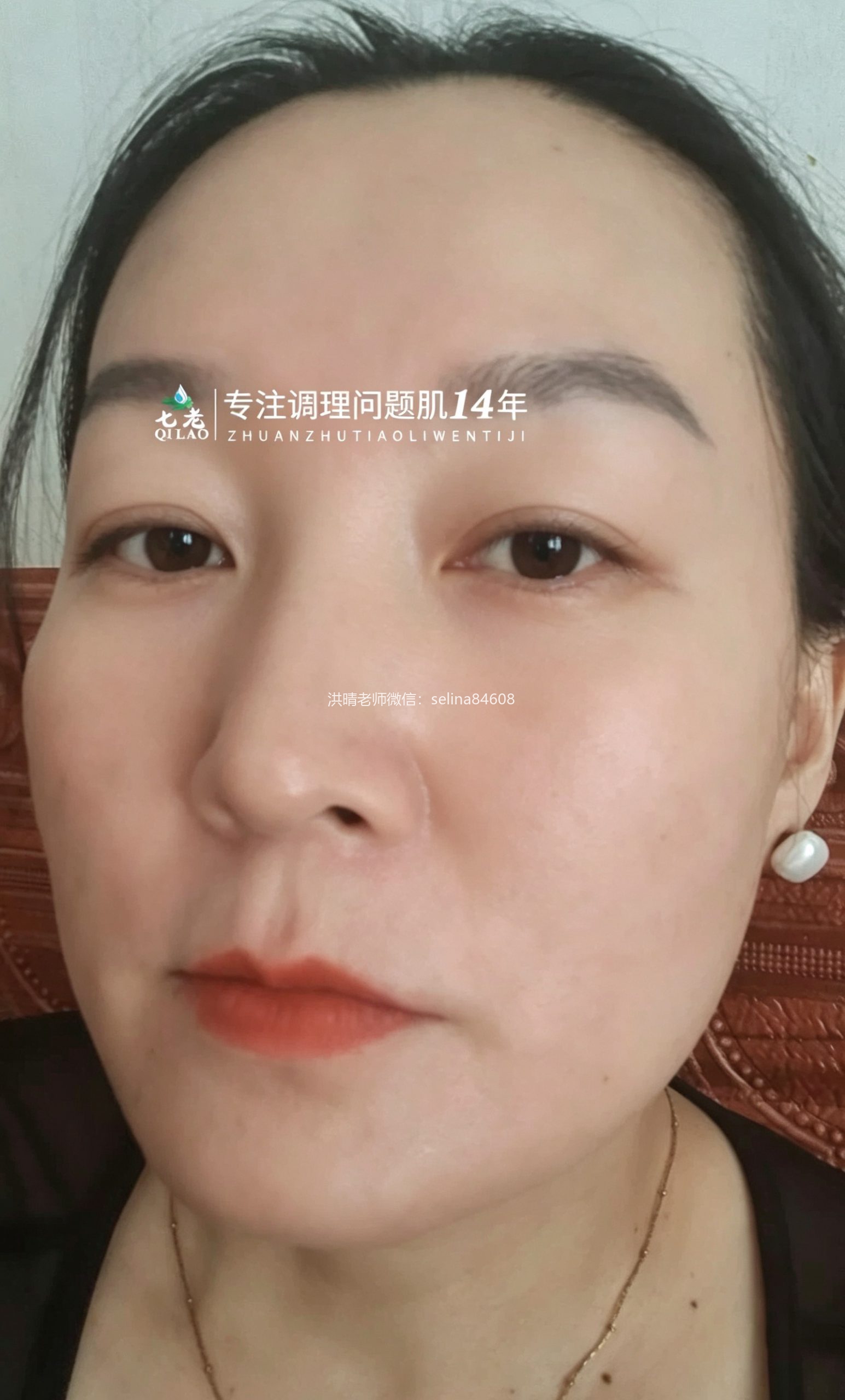 七老急性皮炎湿疹修护案例