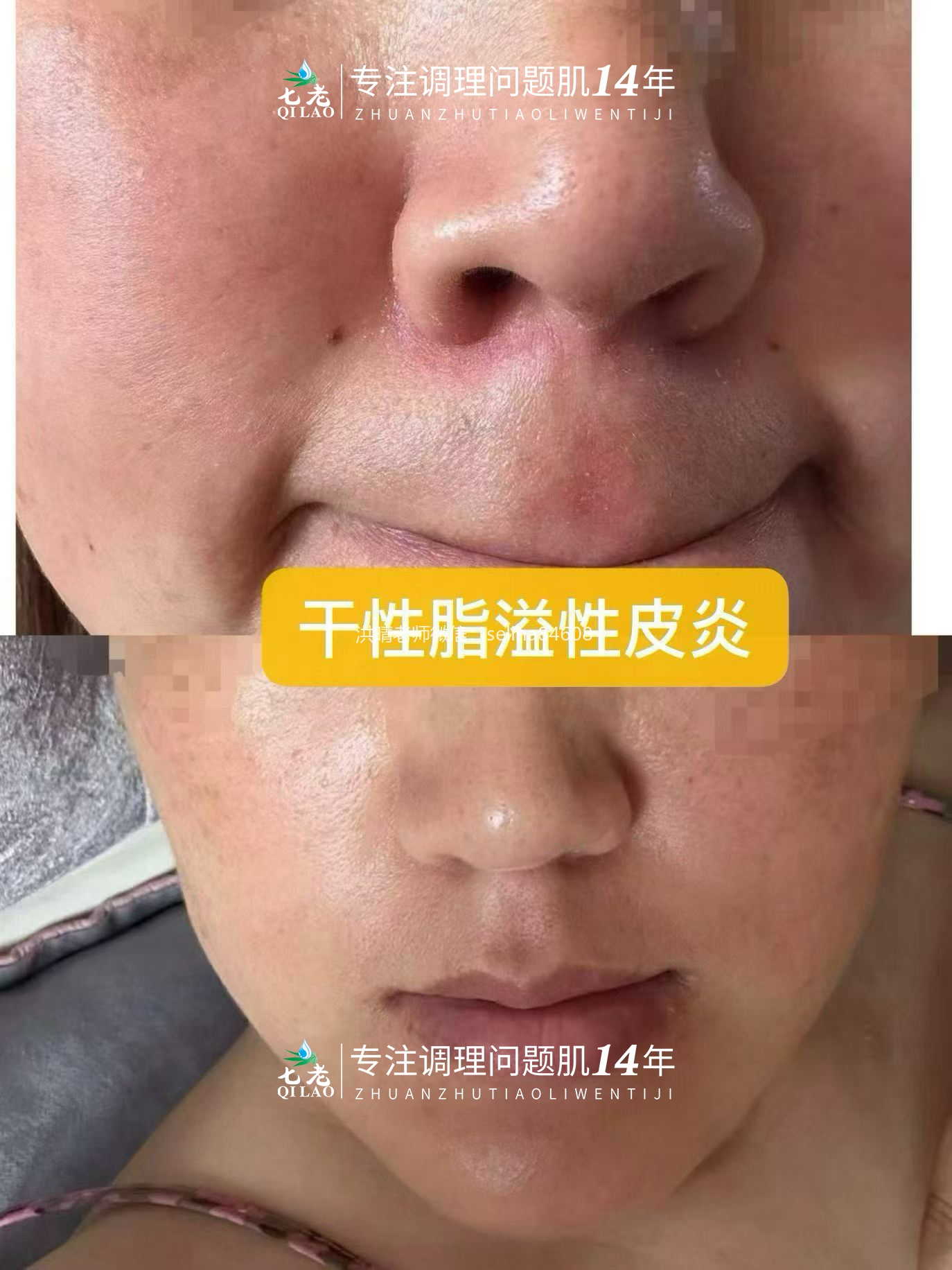七老脂溢性皮炎泛红疹子干痒脱皮修护案例