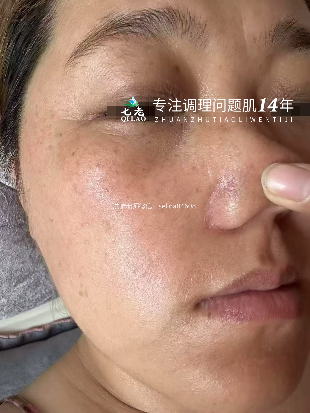 七老脂溢性皮炎泛红疹子干痒脱皮修护案例