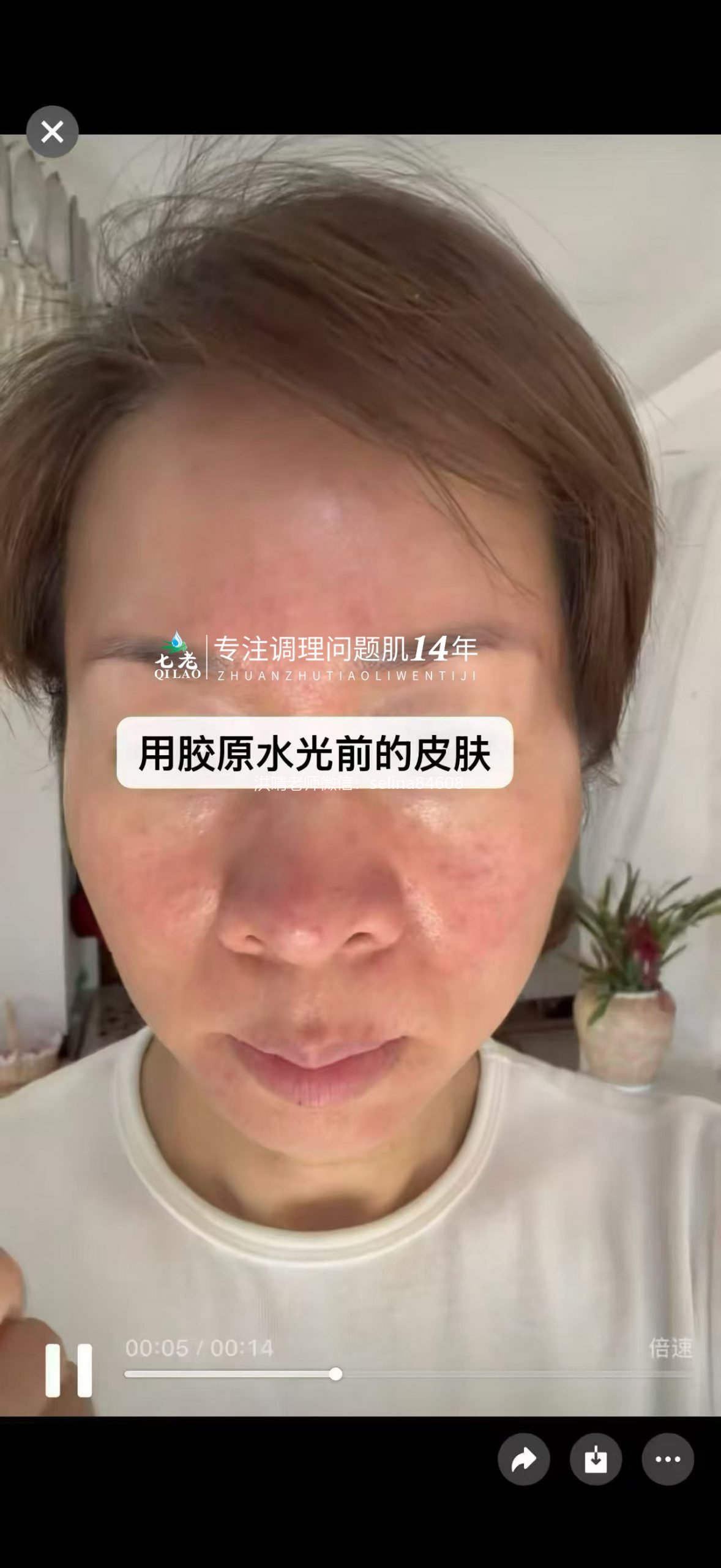 七老激素脸➕玫瑰痤疮➕脂皮修护案例