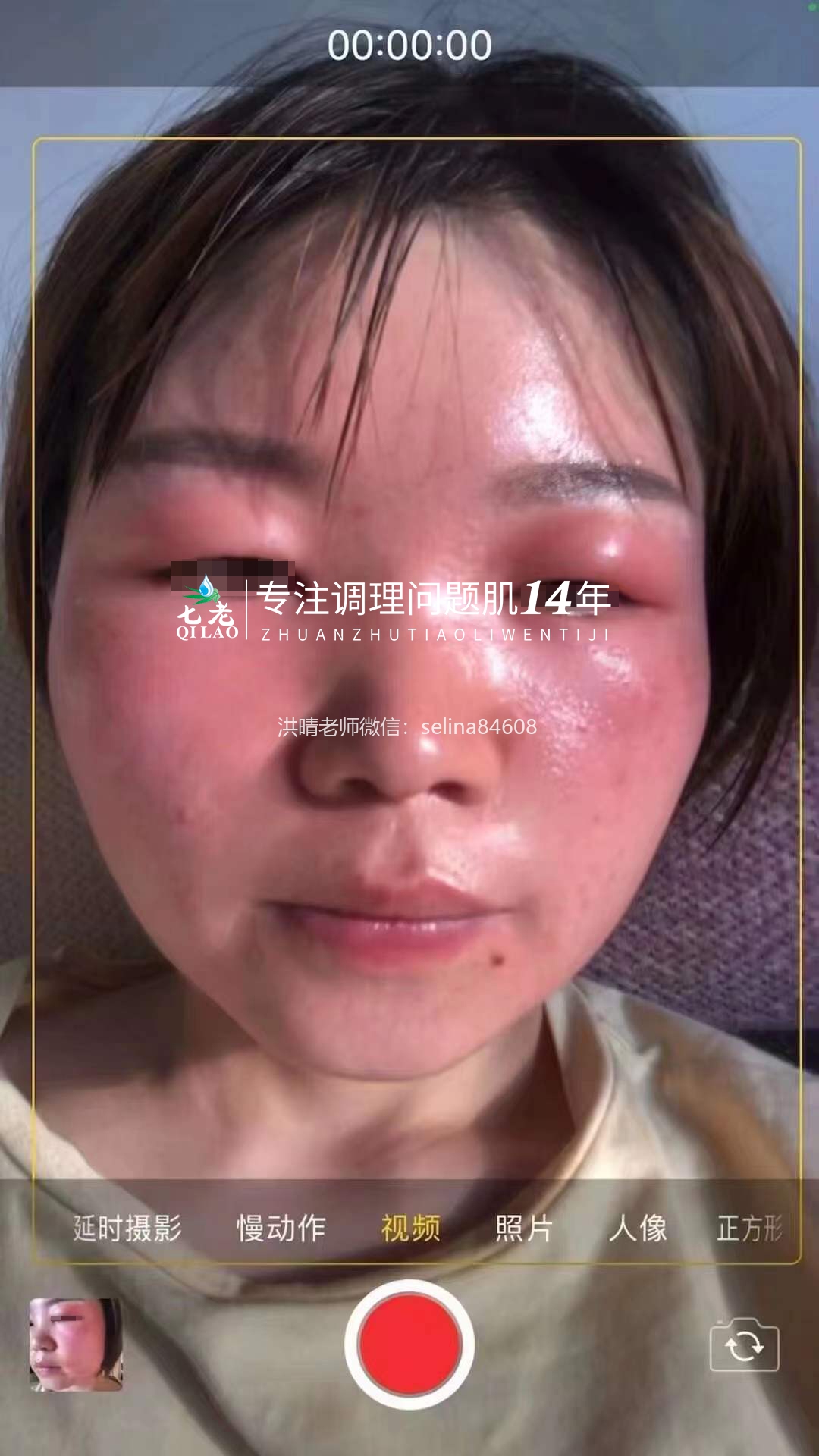 七老激素脸➕脂皮修护案例