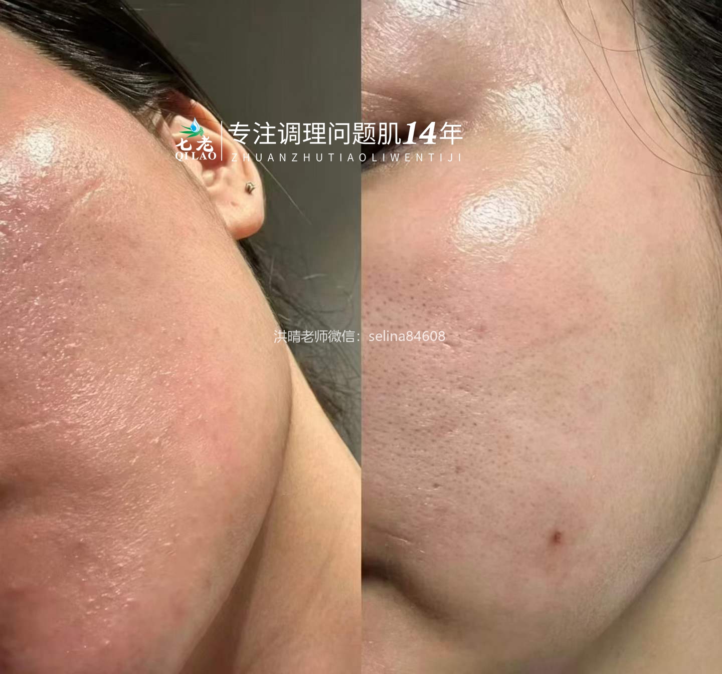 七老油敏疹子修护案例好评反馈