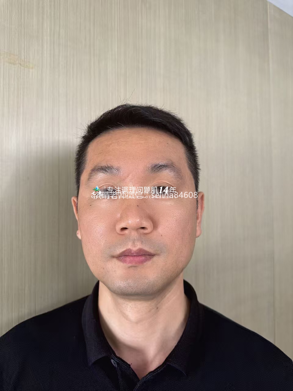 七老十年顽固痘痘肌修护案例