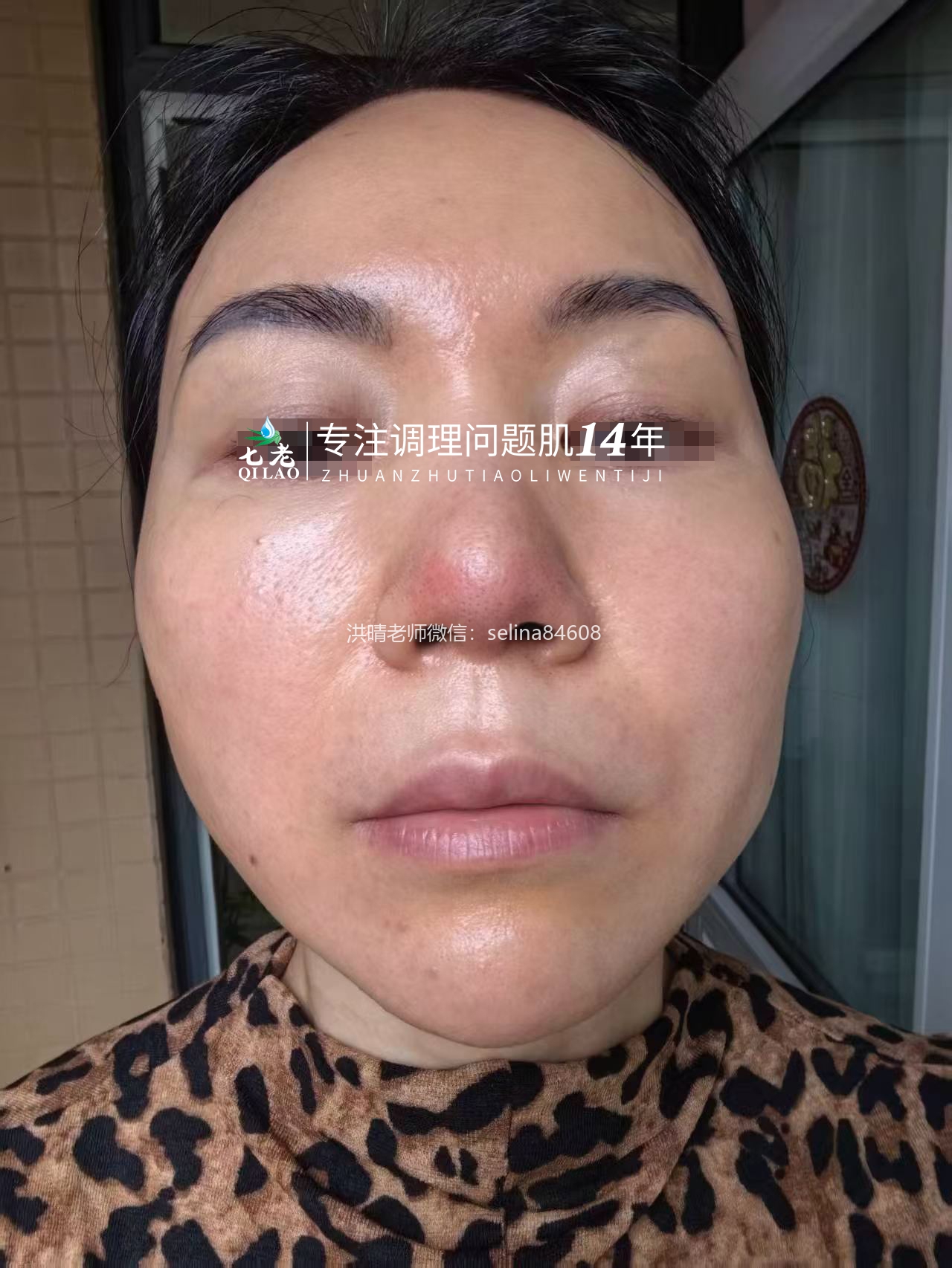 七老屏障受损油敏肌玫瑰痤疮修护案例