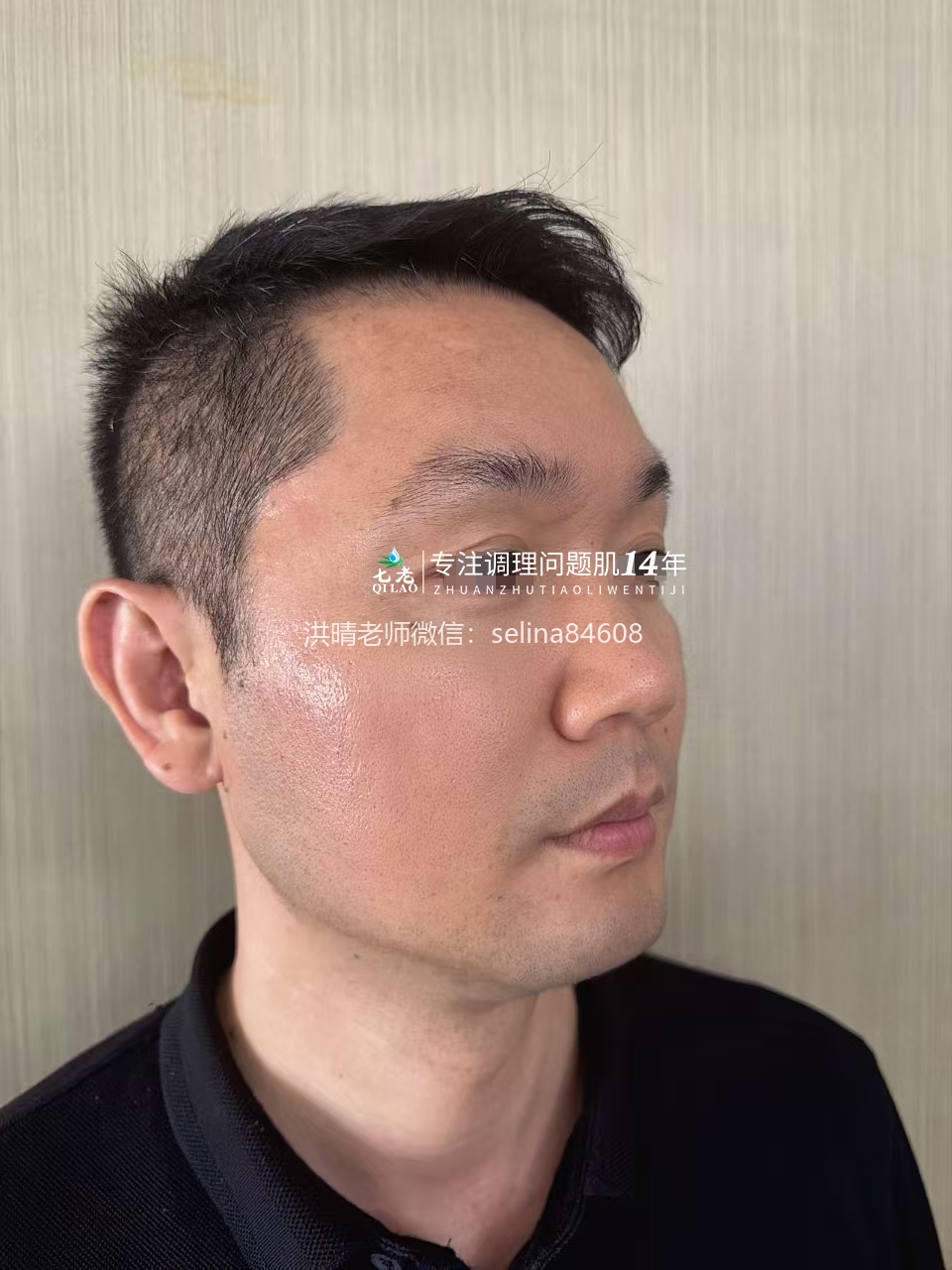 七老十年顽固痘痘肌修护案例