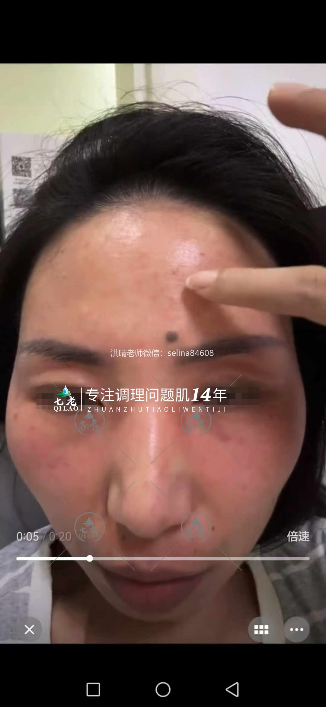 七老激素脸发红发烫修护案例