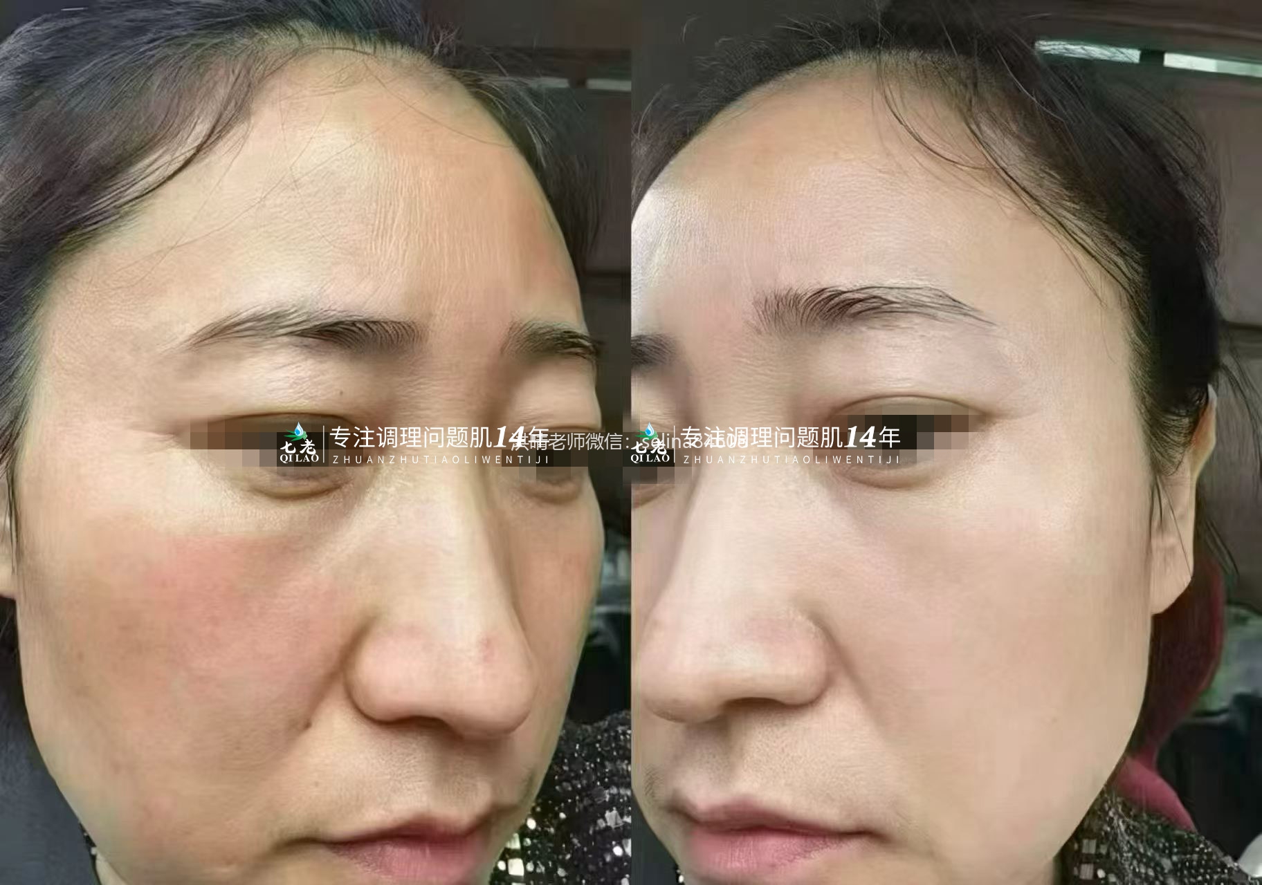 七老激素脸玫瑰痤疮修护案例