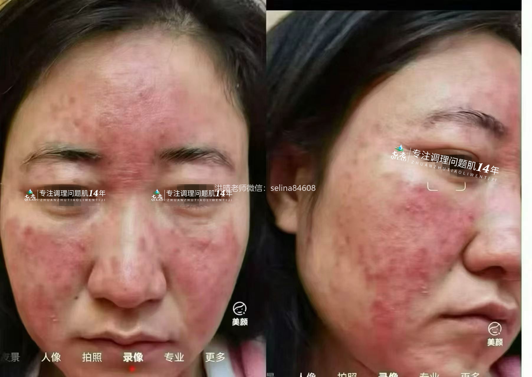 七老激素脸玫瑰痤疮修护案例