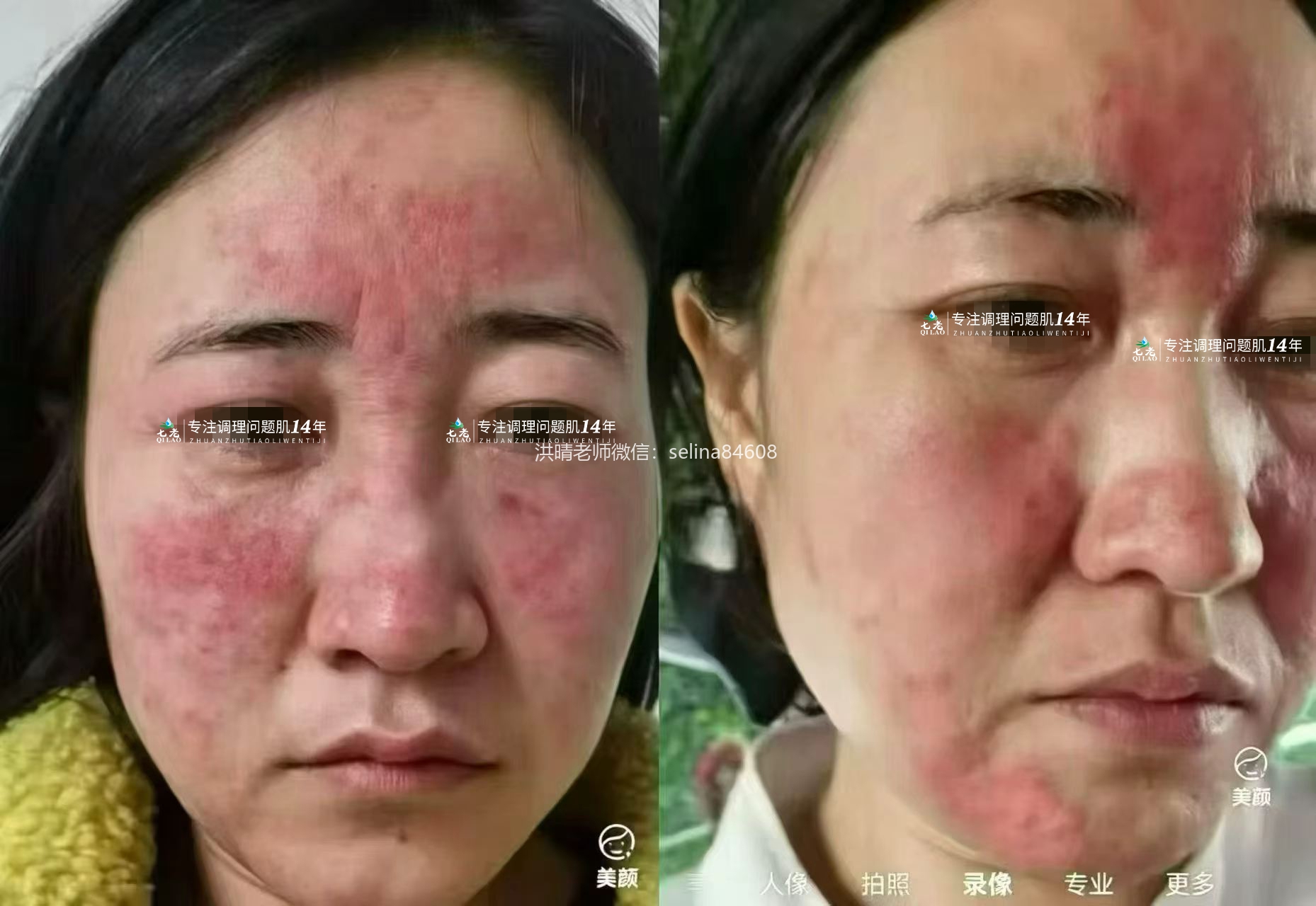 七老激素脸玫瑰痤疮修护案例