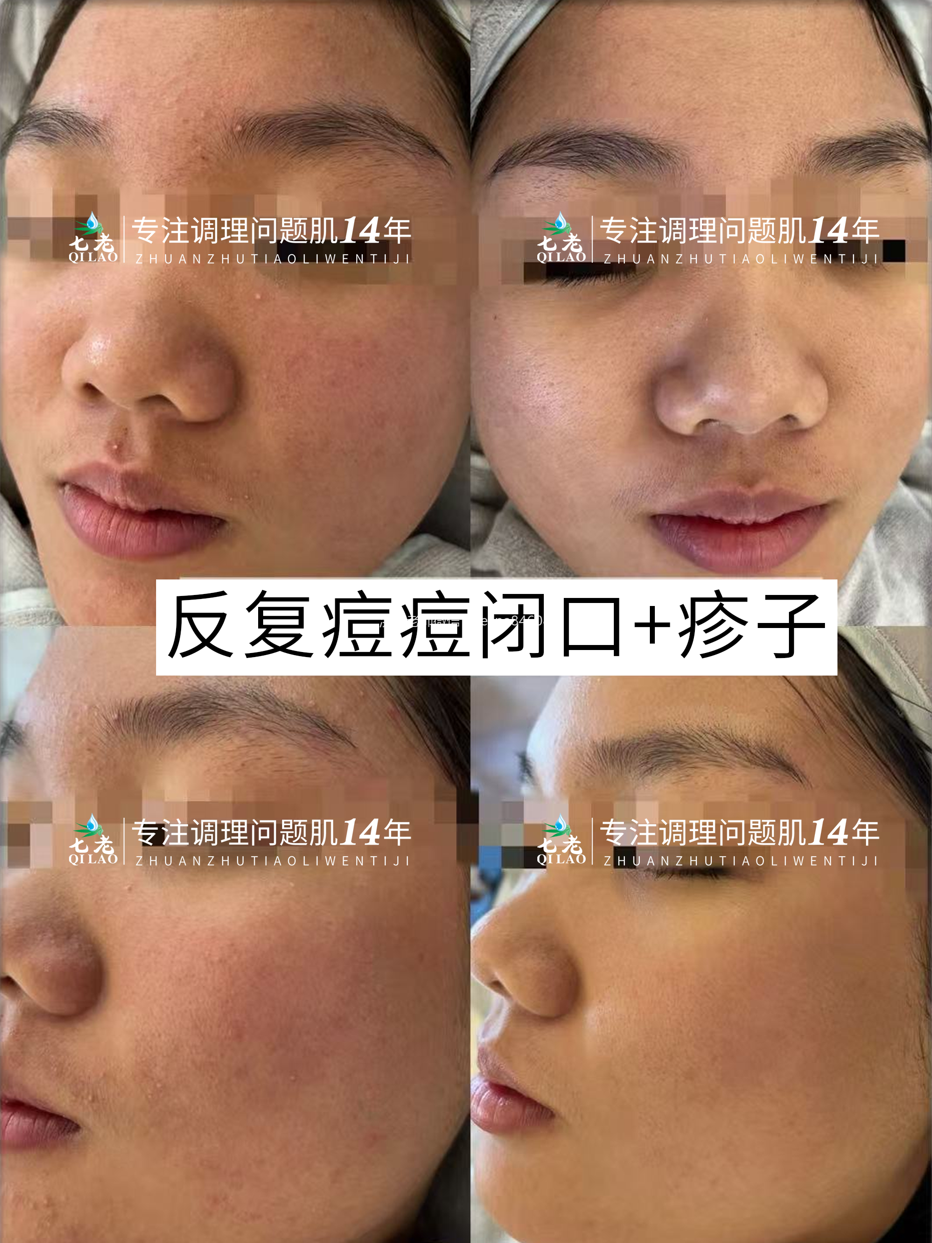 一到夏天就长疹子长疙瘩闭口粉刺痘痘的姐妹一定要看