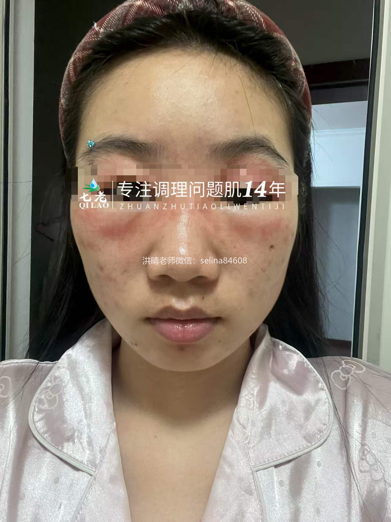 七老眼周反复过敏修护案例