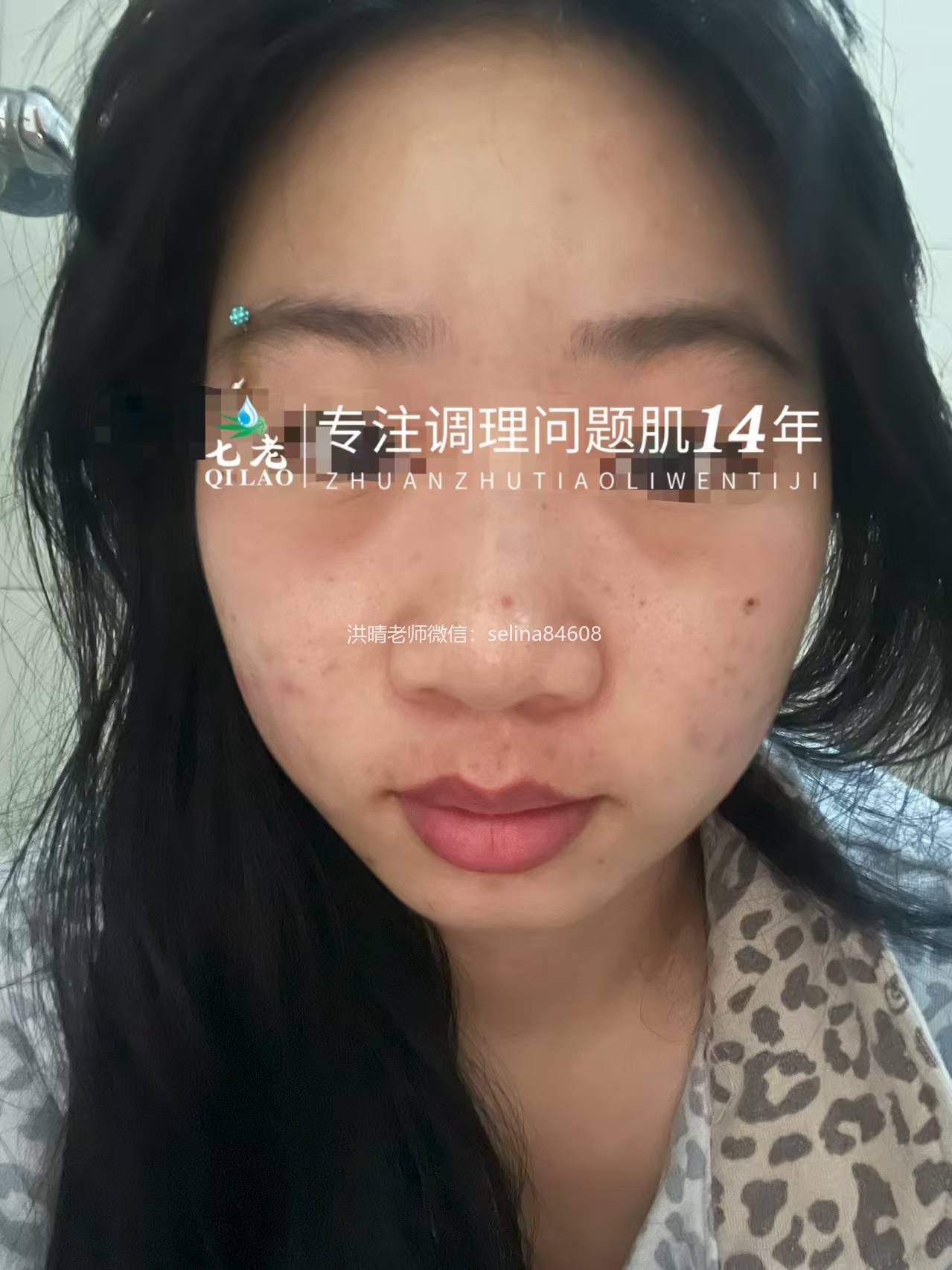 七老眼周反复过敏修护案例