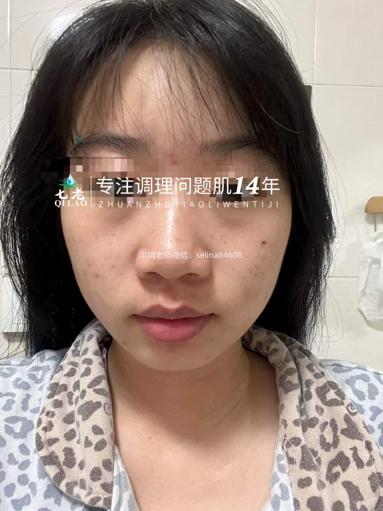 七老眼周反复过敏修护案例