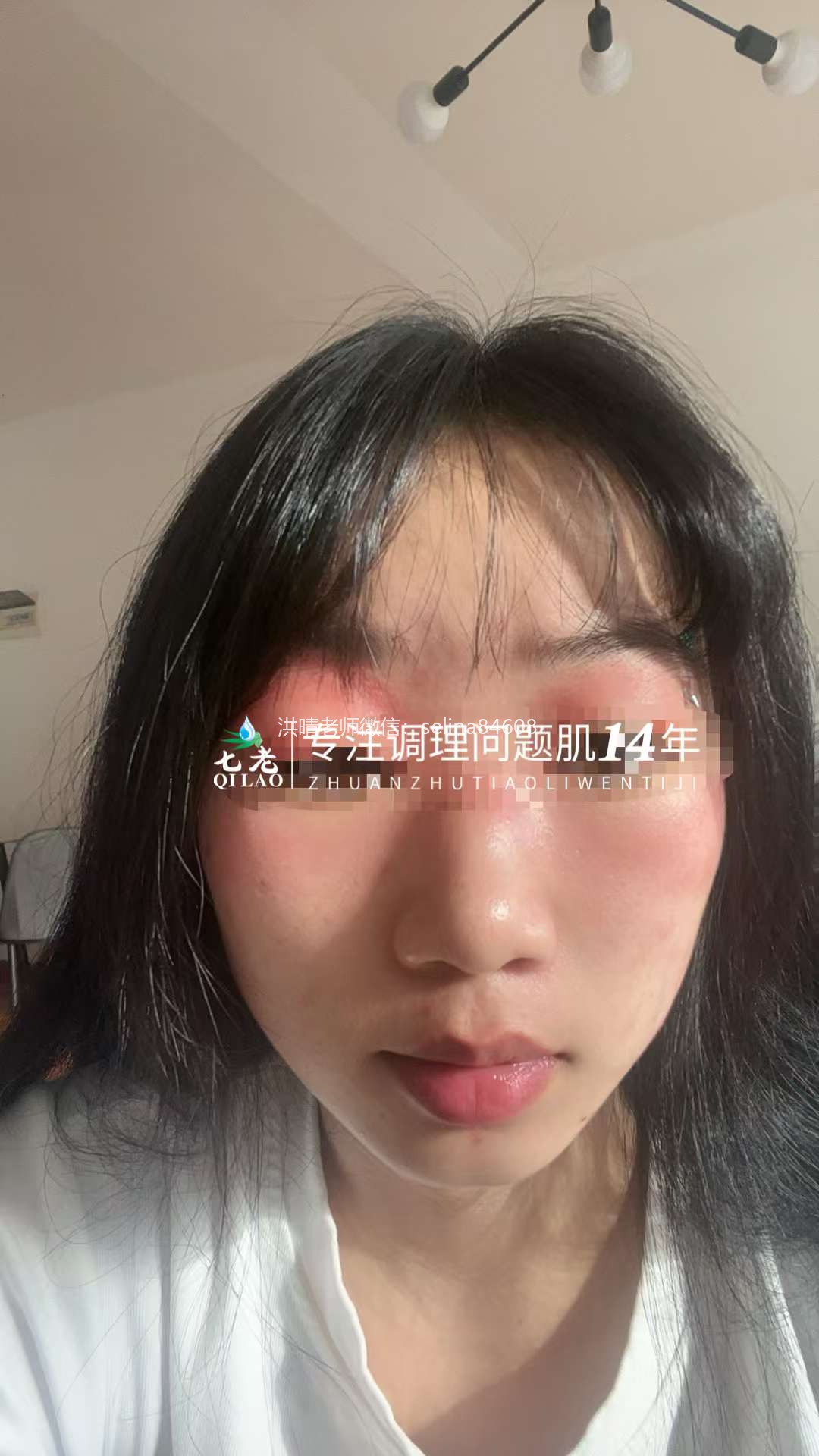 七老眼周反复过敏修护案例