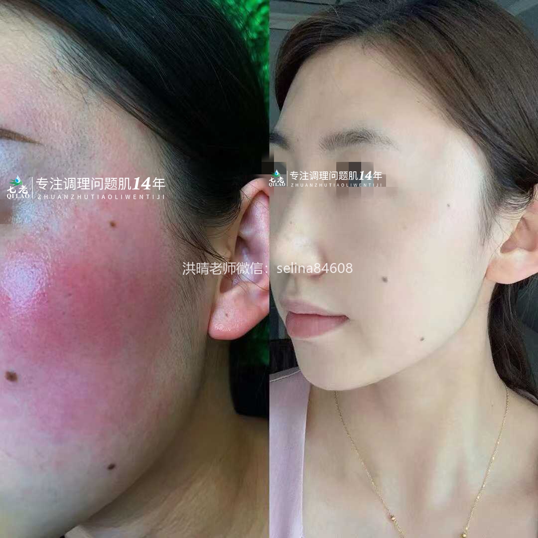 七老红烫肌修护案例