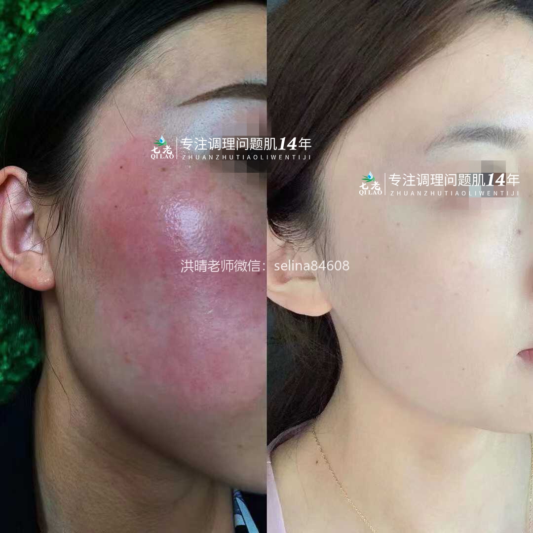 七老红烫肌修护案例