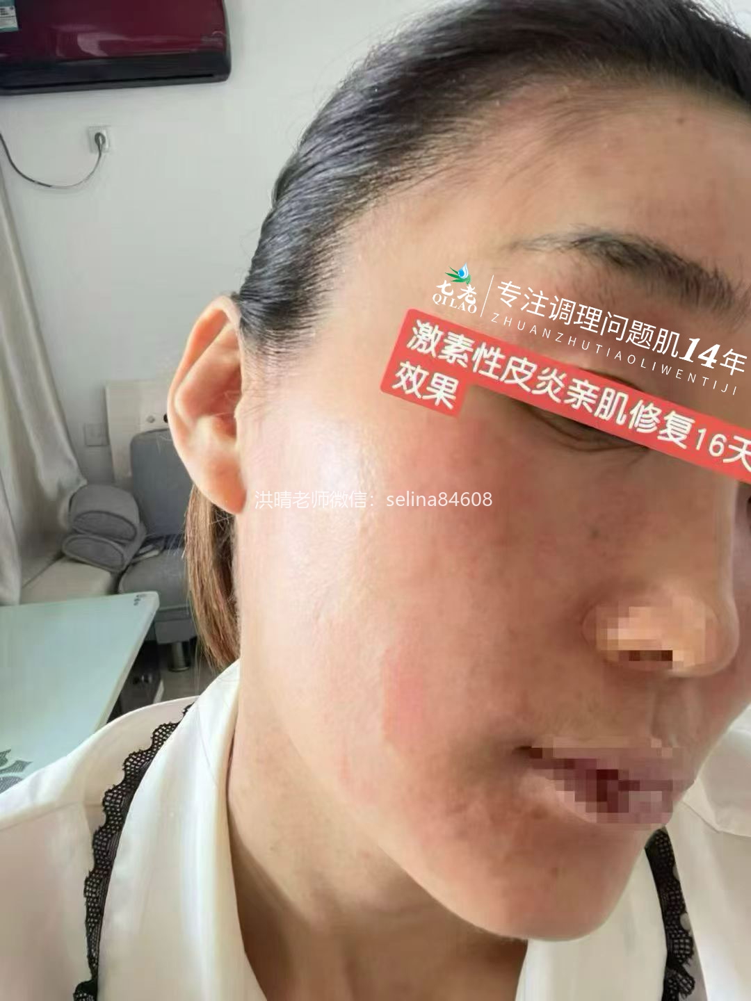 七老激素脸修护记录