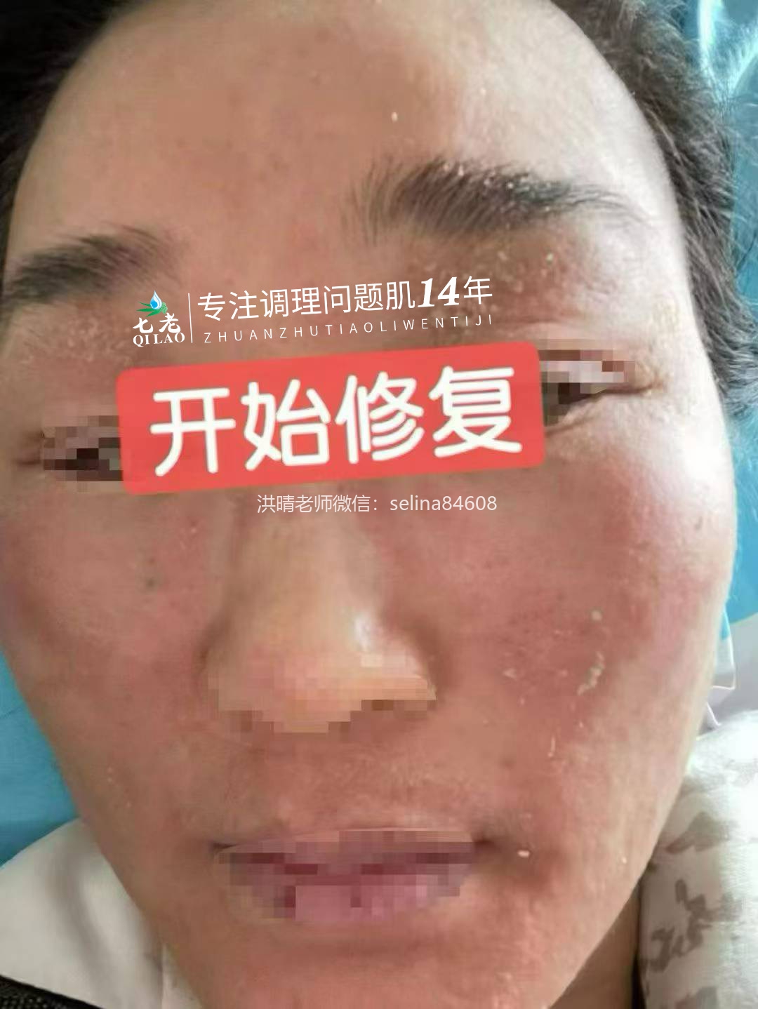 七老激素脸修护记录