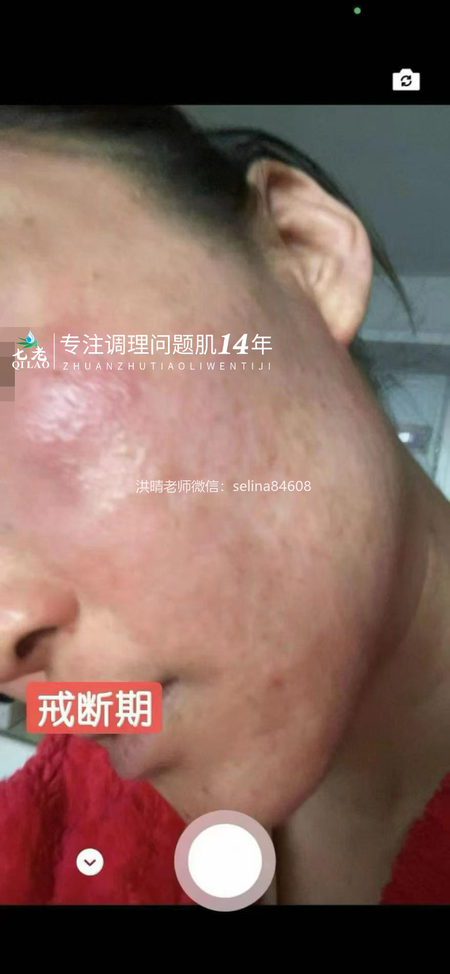 七老激素脸修护记录